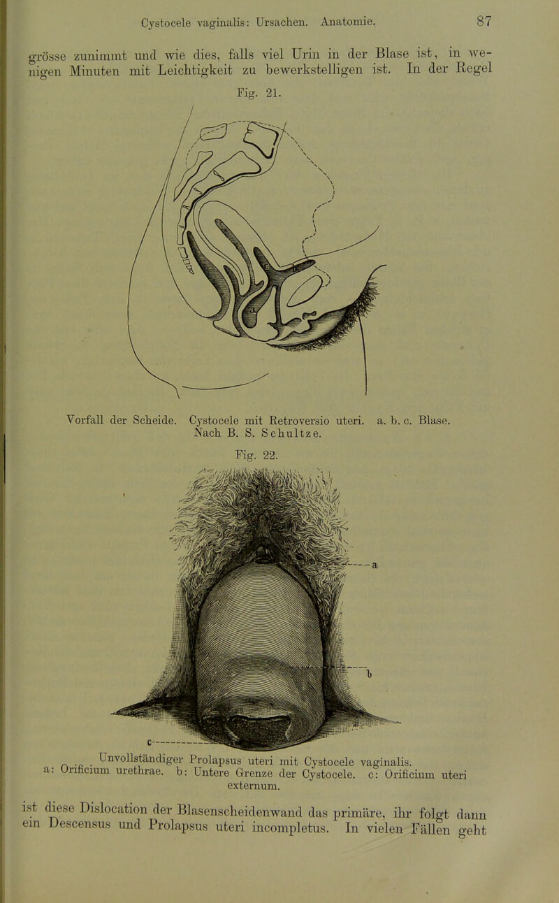 grosse zunimmt micl wie dies, falls viel Urin in der Blase ist, in we- nigen Minuten mit Leichtigkeit zu bewerkstelligen ist. In der Regel Fig. 21. Vorfall der Scheide. Cystocele mit Retroversio uteri, a. b. c. Blase. Nach B. S. Schnitze. Fig. 22. P, .„ . Unvollständiger Prolapsus uteri mit Cystocele vaginalis, a: Urihcium urethrae. b: Untere Grenze der Cystocele. c: Orificium uteri externum. ist diese Dislocation der Blasenscheidenwand das primäre, ihr folgt dann em Descensus und Prolapsus uteri incompletus. In vielen FäUen geht