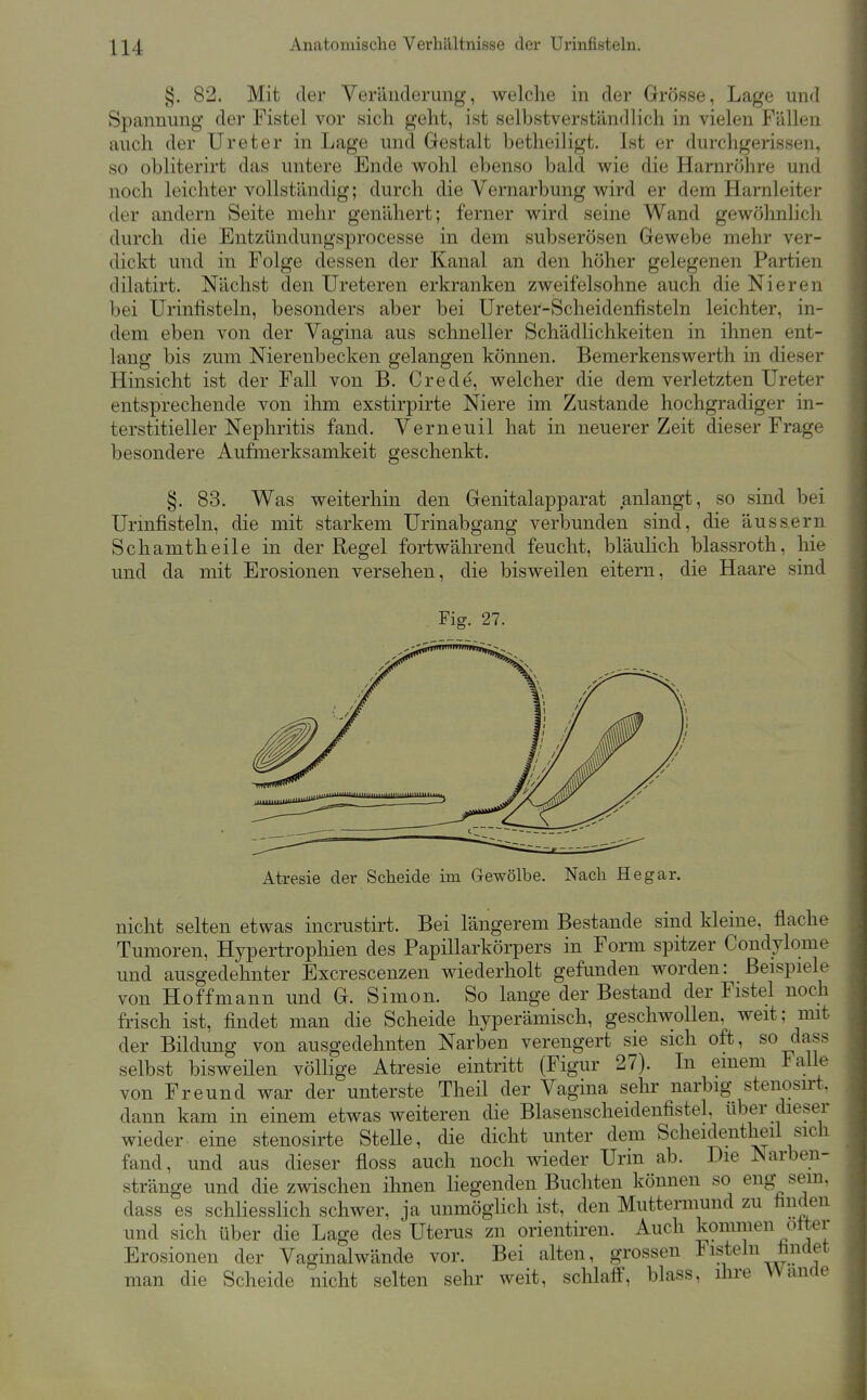 §. 82. Mit der Veränderung, welche in der Grösse, Lage und Spannung der Fistel vor sich geht, ist selbstverständlich in vielen Fällen auch der Ureter in Lage und Gestalt betheiligt. Ist er durchgerissen, so obliterirt das untere Ende wohl ebenso bald wie die Harnröhre und noch leichter vollständig; durch die Vernarbung wird er dem Harnleiter der andern Seite mehr genähert; ferner wird seine Wand gewöhnlich durch die Entzündungsprocesse in dem subserösen Gewebe mehr ver- dickt und in Folge dessen der Kanal an den höher gelegenen Partien dilatirt. Nächst den Ureteren erkranken zweifelsohne auch die Nieren bei Urinfisteln, besonders aber bei Ureter-Scheidenfisteln leichter, in- dem eben von der Vagina aus schneller Schädlichkeiten in ihnen ent- lang bis zum Nierenbecken gelangen können. Bemerkenswerth in dieser Hinsicht ist der Fall von B. Crede, welcher die dem verletzten Ureter entsprechende von ihm exstirpirte Niere im Zustande hochgradiger in- terstitieller Nephritis fand. Verneuil hat in neuerer Zeit dieser Frage besondere Aufmerksamkeit geschenkt. §. 83. Was weiterhin den Genitalapparat anlangt, so sind bei Urmfisteln, die mit starkem Urinabgang verbunden sind, die äussern Schamtheile in der Regel fortwährend feucht, bläulich blassroth, hie und da mit Erosionen versehen, die bisweilen eitern, die Haare sind Fig. 27. Atresie der Scheide im Gewölbe. Nach He gar. nicht selten etwas incrustirt. Bei längerem Bestände sind kleine, flache Tumoren, Hypertrophien des Papillarkörpers in Form spitzer Condylome und ausgedehnter Excrescenzen wiederholt gefunden worden: Beispiele von Hoffmann und G. Simon. So lange der Bestand der Fistel noch frisch ist, findet man die Scheide hyperämisch, geschwollen, weit; mit der Bildung von ausgedehnten Narben verengert sie sich oft, so dass selbst bisweüen völlige Atresie eintritt (Figur 27). In einem Falle von Freund war der unterste Theil der Vagina sehr narbig stenosirt. dann kam in einem etwas weiteren die Blasenscheidenfistel, über dieser wieder eine stenosirte SteUe, die dicht unter dem Scheidentheil sich fand, und aus dieser floss auch noch wieder Urm ab. Die Narben- stränge und die zwischen ihnen liegenden Buchten können so eng sein, dass es schliesslich schwer, ja unmöglich ist, den Muttermund zu finden und sich über die Lage des Uterus zn orientiren. Auch kommen otter Erosionen der Vaginalwände vor. Bei alten, grossen Fisteln findet man die Scheide nicht selten sehr weit, schlaff, blass, ihre Wände