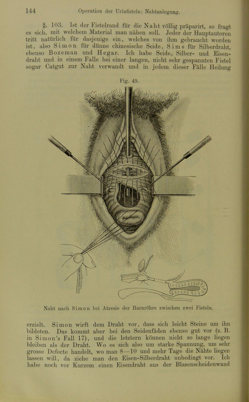 §. 103. Ist der Fistelrand für die Naht völlig präparirt, so fragt es sich, mit welchem Material man nähen soll. Jeder der Hauptautoren tritt natürlich für dasjenige ein, welches von ihm gebraucht worden ist, also Simon für dünne chinesische Seide, Sims für Silberdraht, ebenso Bozeman und Hegar. Ich habe Seide, Silber- und Eisen- draht und in einem Falle bei einer langen, nicht sehr gespannten Fistel sogar Catgut zur Naht verwandt und in jedem dieser Fälle Heilung Fig. 49. Naht nach Simon bei Atresie der Harnröhre zwischen zwei Fisteln. erzielt. Simon wirft dem Draht vor, dass sich leicht Steine um ihn bildeten. Das kommt aber bei den Seidenfäden ebenso gut vor (z. B. in Simon's Fall 17), und die letztern können nicht so lange liegen bleiben als der Draht. Wo es sich also um starke Spannung, um sehr grosse Defecte handelt, wo man 8—10 und mehr Tage die Nähte liegen lassen wül, da ziehe man den Eisen-Silberdraht unbedingt vor. Ich habe noch vor Kurzem einen Eisendraht aus der Blasenscheidenwand