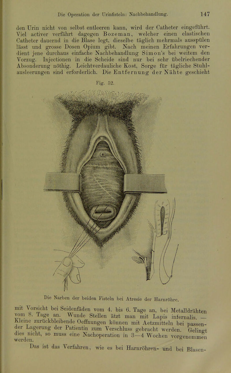 den Urin nicht von selbst entleeren kann, wird der Catheter eingeführt. Viel activer verfährt dagegen Bozeman, welcher einen elastischen Catheter dauernd in die Blase legt, dieselbe täglich mehrmals ausspülen lässt und grosse Dosen Opium gibt. Nach meinen Erfahrungen ver- dient jene durchaus einfache Nachbehandlung Simon's bei weitem den Vorzug. Injectionen in die Scheide sind nur bei sehr übelriechender Absonderung nöthig. Leichtverdauliche Kost, Sorge für tägliche Stuhl- ausleerungen sind erforderhch. Die Entfernung der Nähte geschieht Fig. 52. Die Narben der beiden Fisteln bei Atresie der Harnröhre. mit Vorsicht bei Seidenfäden vom 4. bis 6. Tage an, bei Metalldrähten vom 8. Tage an. Wunde SteUen ätzt man mit Lapis infernalis — Kieme zurückbleibende Oeffnungen können mit Aetzmitteln bei passen- der Lagerung der Patientin zum Verschluss gebracht werden Gelingt dies nicht, so muss eine Nachoperation in 3—4 Wochen vorgenommen werden. ^ Das ist das Verfahren, wie es bei Harnröhren- und bei Blasen-