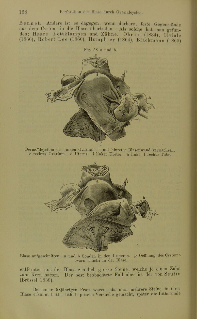 Beim et. Anders ist es dagegen, wenn derbere, feste Gegenstände aus dem Cystom in die Blase üLertreten. Als solche hat man gefun- den: Haare, Pettklumpen und Zähne. Obrien (1834), Civiale (1860), Robert Lee (1860), Humphrey (1864), Blackmann (1869) Fig. 58 a und b. c 1 Dermoidcystom .des linken Ovariums k mit hinterer Blasenwand verwachsen, e rechtes Ovarium. d Uterus, i linker Ureter, h linke, f rechte Tube. c Blase aufgeschnitten, a und b Sonden in den Ureteren. g Oeflfnung des Cystoma ovarii sinistri in der Blase. entfernten aus der Blase ziemlich grosse Steine, welche je einen Zahn zum Kern hatten. Der best beobachtete Fall aber ist der von Seutin (Brüssel 1838). Bei einer 58jährigen Frau waren, da man mehrere Steine_ in ihrer Blase erkannt hatte, lithotriptische Versuche gemacht, später die Lithotomie