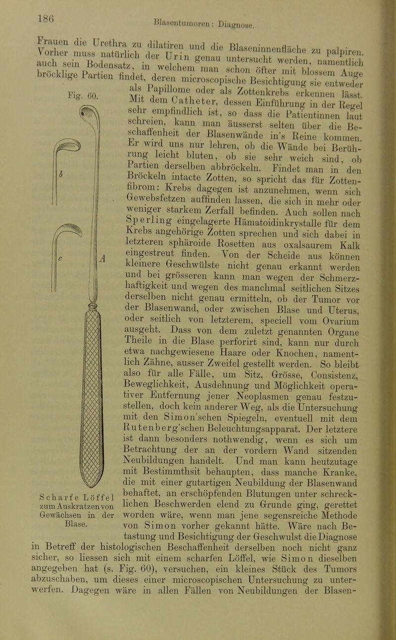 18G sehr emphndlich ist, so dass die Patientinnen laut schreien kann man äusserst selten über die ße- schaftenheit der Blasenwände in's Reine kommen -h^r wird uns nur lehren, ob die Wände bei Berüh- rung leicht bluten, ob sie sehr weich sind, ob Partien derselben abbröckeln. Findet man in den Brockein mtacte Zotten, so spricht das für Zotten- übrom: Krebs dagegen ist anzunehmen, wenn sich . brewebstetzen auffinden lassen, die sich in mehr oder weniger starkem Zerfall befinden. Auch sollen nach bperlmg eingelagerte HämatoidinkrystaUe für dem Krebs angehörige Zotten sprechen und sich dabei in letzteren sphäroide Rosetten aus oxalsaurem Kalk eingestreut finden. Von der Scheide aus können kleinere Geschwülste nicht genau erkannt werden und bei grösseren kann man wegen der Schmerz- haftigkeit und wegen des manchmal seitlichen Sitzes derselben nicht genau ermitteln, ob der Tumor vor der Blasenwand, oder zwischen Blase und Uterus, oder seitlich von letzterem, speciell vom Ovarium ausgeht. Dass von dem zuletzt genannten Organe Theile in die Blase perforirt sind, kann nur durch etwa nachgewiesene Haare oder Knochen, nament- lich Zähne, ausser Zweifel gestellt werden. So bleibt also für alle Fälle, um Sitz, Grösse, Consistenz, Beweglichkeit, Ausdehnung und Möglichkeit opera- tiver Entfernung jener Neoplasmen genau festzu- gK/Ä<J stellen, doch kein anderer Weg, als die Untersuchung mit den Simon'schen Spiegeln, eventuell mit dem Rutenb erg'schen Beleuchtungsapparat. Der letztere ist dann besonders nothwendig, wenn es sich um Betrachtung der an der vordem Wand sitzenden Neubildungen handelt. Und man kann heutzutage mit Bestimmthsit behaupten, dass manche Kranke, die mit einer gutartigen Neubildung der Blasenwand Scharfe Löffel ^^^^^^^t, an erschöpfenden Blutungen unter schreck- zum Auskratzen von Richen Beschwerden elend zu Grunde ging, gerettet Gewächsen in der worden wäre, wenn man jene segensreiche Methode Blase. von Simon vorher gekannt hätte. Wäre nach Be- tastung und Besichtigung der Geschwulst die Diagnose in Betreff der histologischen Beschaffenheit derselben noch nicht ganz sicher, so Hessen sich mit einem scharfen Löffel, wie Simon dieselben angegeben hat (s. Fig. 60), versuchen, ein kleines Stück des Tumors abzuschaben, um dieses einer microscopischen Untersuchung zu unter- werfen. Dagegen wäre in allen Fällen von Neubildungen der Blasen-