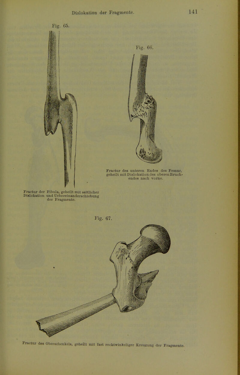 Fig. 65. Fractur der Fibula, geheilt mit seitlicher Dislokation und Uebereinanderschiebung der Fragmente. Fig. 67.