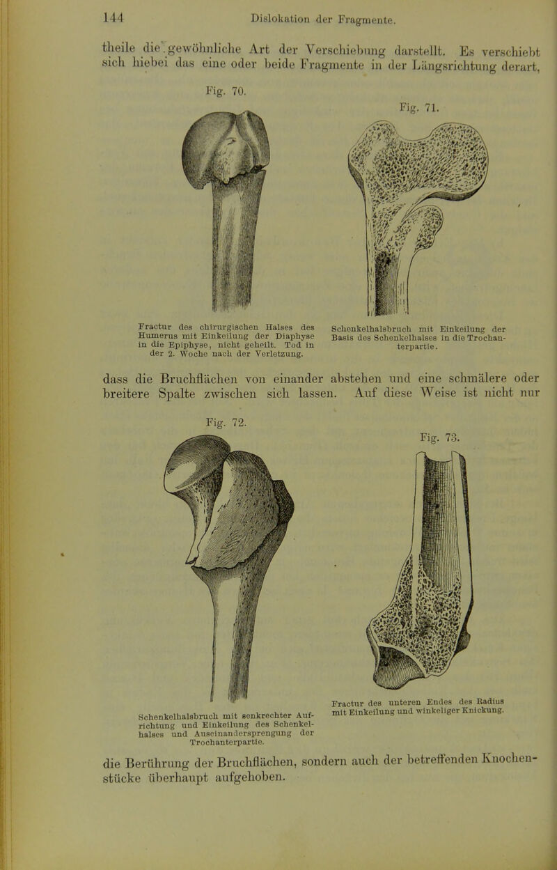 theile die ■ gewöhnliche Art der Verschiebung darstellt. Es verschiebt sich hiebei das eine oder beide Fragmente in der Längsrichtung derart, Fig. 70. Fractur des chirurgischen Halses des Humerus mit Einkeilung der Diaphyse in die Epiphyse, nicht geheilt. Tod in der 2. Woche nach der Verletzung. Fig. 71. Schenkelhalsbruch mit Einkeilung der Basis des Schenkelhalses in die Trochan- terpartie. dass die Bruchflächen von einander abstehen und eine schmälere oder breitere Spalte zwischen sich lassen. Auf diese Weise ist nicht nur Fig. 72. Fig. 73. Schenkelhalsbruch mit senkrechter Auf- richtung und Einkeilung des Schenkel- halses und Auseinandersprengung der Trochanterpartte. Fractur des unteren Endes des Radius mit Einkeilung und winkeliger Knickung. die Berührung der Bruchflächen, sondern auch der betreffenden Knochen- stücke überhaupt aufgehoben.