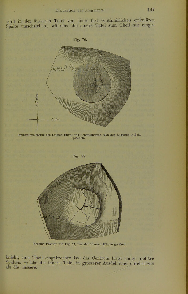 wird in der äusseren Tafel von einer fast continuirlichen cirkulären Spalte umschrieben, während die innere Tafel zum Theil nur einge- Fig. 76. Depressionsfractur des rechten Stirn- und Scheitelbeines von der äusseren Fläche gesehen. Fig. 77. Dieselbe Fractur wie Fig. 76, von der inneren Fläche gesehen. knickt, zum Theil eingebrochen ist; das Centrum trägt einige radiäre Spalten, welche die innere Tafel in grösserer Ausdehnung durchsetzen als die äussere.