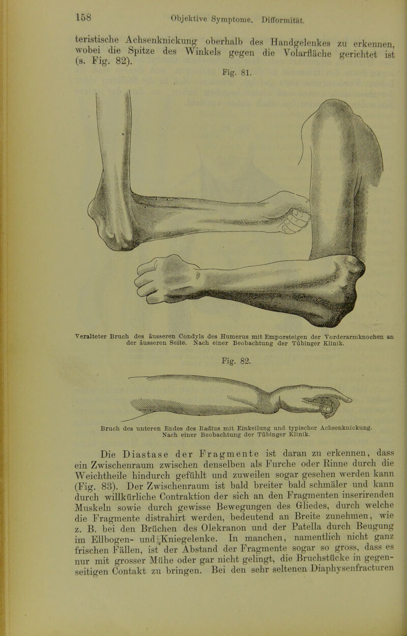 teristische Achsenknickung oberhalb des Handgelenkes zu erkennen wobei die Spitze des Winkels gegen die Volarfläche gerichtet ist (s. Fig. 82). Fig. 81. Veralteter Bruch des äusseren Condyls des Humerus mit Emporsteigen der Vorderarmknochen an der äusseren Seite. Nach einer Beobachtung der Tübinger Klinik. Fig. 82. Bruch des unteren Endes des Badius mit Einkeilung und typischer Achsenknickung. Nach einer Beobachtung der Tübinger Klinik. Die Diastase der Fragmente ist daran zu erkennen, dass ein Zwischenraum zwischen denselben als Furche oder Rinne durch die Weichtheile hindurch gefühlt und zuweilen sogar gesehen werden kann (Fig. 83). Der Zwischenraum ist bald breiter bald schmäler und kann durch willkürliche Contraktion der sich an den Fragmenten inserirenden Muskeln sowie durch gewisse Bewegungen des Gliedes, durch welche die Fragmente distrahirt werden, bedeutend an Breite zunehmen, wie z. B. bei den Brüchen des Olekranon und der Patella durch Beugung im Ellbogen- und ^Kniegelenke. In manchen, namentlich nicht ganz frischen Fällen, ist der Abstand der Fragmente sogar so gross, dass es nur mit grosser Mühe oder gar nicht gelingt, die Bruchstücke in gegen- seitigen Contakt zu bringen. Bei den sehr seltenen Diaphysenfracturen