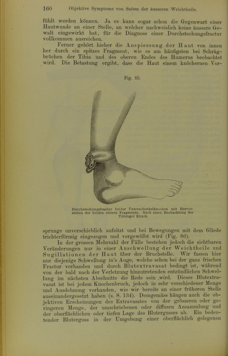 fühlt werden können. Ja es kann sogar schon die Gegenwart einer Hautwunde an einer Stelle, an welcher nachweislich keine äussere Ge- walt eingewirkt hat, für die Diagnose einer Durchstechungsfractur vollkommen ausreichen. Ferner gehört hieher die Anspiessung der Haut von innen her durch ein spitzes Fragment, wie es am häufigsten hei Schräg- brüchen der Tibia und des oberen Endes des Humerus beobachtet wird. Die Betastung ergibt, dass die Haut einem knöchernen Vor- Fig. 85. Durchstechungsfractur beider Unterschenkelknochen mit Hervor- stehen der beiden oberen Fragmente. Nach einer Beobachtung der Tübinger Klinik. sprunge unverschieblich aufsitzt und bei Bewegungen mit dem Grliede trichterförmig eingezogen und vorgewölbt wird (Fig. 86). In der grossen Mehrzahl der Fälle bestehen jedoch die sichtbaren Veränderungen nur in einer Anschwellung der Weichtheile und Sugillationen der Haut über der Bruchstelle. Wir fassen hier nur diejenige Schwellung in's Auge, welche schon bei der ganz frischen Fractur vorhanden und durch Blutextravasat bedingt ist, während von der bald nach der Verletzung hinzutretenden entzündlichen Schwel- lung im nächsten Abschnitte die Rede sein .wird. Dieses Blutextra- vasat ist bei jedem Knochenbruch, jedoch in sehr verschiedener Menge und Ausdehnung vorhanden, wie wir bereits an einer früheren Stelle auseinandergesetzt haben (s. S. 134). Demgemäss hängen auch die ob- jektiven Erscheinungen des Extravasates von der grösseren oder ge- ringeren Menge, der umschriebenen oder diffusen Ansammlung und der oberflächlichen oder tiefen Lage des Blutergusses ab. Ein bedeu- tender Blutergnss in der Umgebung einer oberflächlich gelegenen