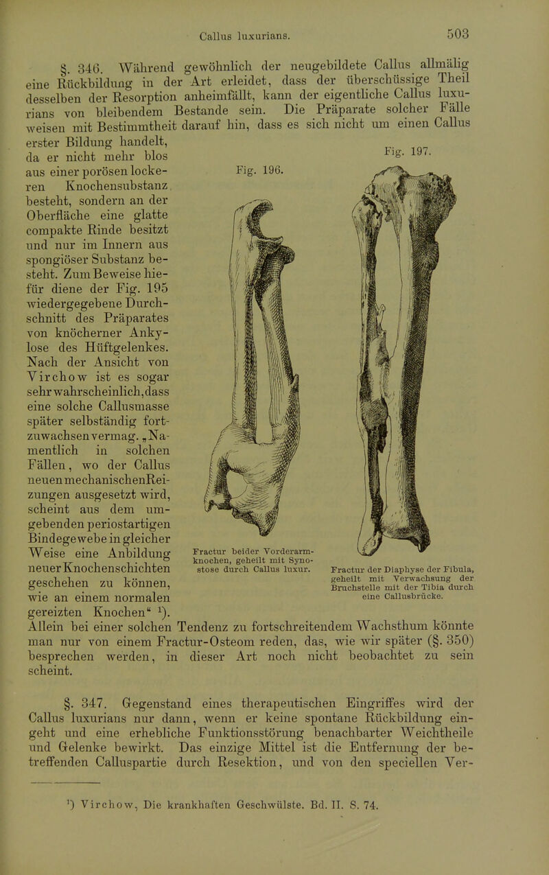 8. 346. Während gewöhnlich der neugebildete Callus allmälig eine Rückbildung in der Art erleidet, dass der überschüssige Theil desselben der Resorption anheimfällt, kann der eigentliche Callus luxu- rians von bleibendem Bestände sein. Die Präparate solcher Fälle weisen mit Bestimmtheit darauf hin, dass es sich nicht um einen Callus erster Bildung handelt, da er nicht mehr blos FlS- 197- aus einer porösen locke- Fig. 196. ren Knochensubstanz besteht, sondern an der Oberfläche eine glatte compakte Rinde besitzt und nur im Innern aus spongiöser Substanz be- steht. Zum Beweise hie- für diene der Fig. 195 wiedergegebene Durch- schnitt des Präparates von knöcherner Anky- lose des Hüftgelenkes. Nach der Ansicht von Virchow ist es sogar sehr wahrscheinlich, dass eine solche Callusmasse später selbständig fort- zuwachsen vermag. „Na- mentlich in solchen Fällen, wo der Callus neuen mechanischenRei- zungen ausgesetzt wird, scheint aus dem um- gebenden periostartigen Bindegewebe in gleicher Weise eine Anbildung neuer Knochenschichten geschehen zu können, wie an einem normalen gereizten Knochen 1). Allein bei einer solchen Tendenz zu fortschreitendem Wachsthum könnte man nur von einem Fractur-Osteom reden, das, wie wir später (§. 350) besprechen werden, in dieser Art noch nicht beobachtet zu sein scheint. Fractur beider Vorderarm- knochen, geheilt mit Syno- stose durch Callus luxur. Fractur der Diaphyse der Fibula, geheilt mit Verwachsung der Bruchstelle mit der Tibia durch eine Callusbrücke. §. 347. Gegenstand eines therapeutischen Eingriffes wird der Callus luxurians nur dann, wenn er keine spontane Rückbildung ein- geht und eine erhebliche Funktionsstörung benachbarter Weichtheile und Gelenke bewirkt. Das einzige Mittel ist die Entfernung der be- treffenden Calluspartie durch Resektion, und von den speciellen Ver- ') Virchow, Die krankhaften Geschwülste. Bd. II. S. 74.