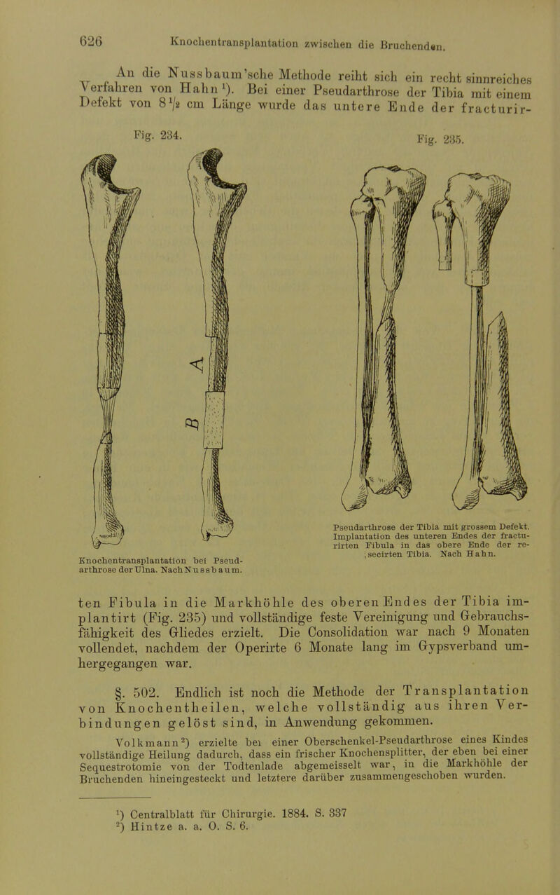 An die Nuss bäum'sehe Methode reiht sich ein recht sinnreiches Verfahren von Hahn1). Bei einer Pseudarthrose der Tibia mit einem Defekt von S^s cm Länge wurde das untere Ende der fracturir- Fig. 234. Fig. 235. 11 Knochentransplantation bei Pseud- arthrose derUlna. NachNussbaum. Pseudarthrose der Tlbia mit grossem Defekt. Implantation des unteren Endes der fractu- rirten Fibula in das obere Ende der re- , secirten Tibia. Nach Hahn. ten Fibula in die Markhöhle des oberenEndes der Tibia im- plantirt (Fig. 235) und vollständige feste Vereinigung und Gebrauchs- fähigkeit des Gliedes erzielt. Die Consolidation war nach 9 Monaten vollendet, nachdem der Operirte 6 Monate lang im Gypsverband um- hergegangen war. §. 502. Endlich ist noch die Methode der Transplantation von Knochentheilen, welche vollständig aus ihren Ver- bindungen gelöst sind, in Anwendung gekommen. Volkmann2) erzielte bei einer Oberschenkel-Pseudarthrose eines Kindes vollständige Heilung dadurch, dass ein frischer Knochensplitter, der eben bei einer Sequestrotomie von der Todtenlade abgemeisselt war, in die Markhohle der Bruchenden hineingesteckt und letztere darüber zusammengeschoben wurden. 0 Centralblatt für Chirurgie. 1884. S. 337 2) Hintze a. a. 0. S. 6.