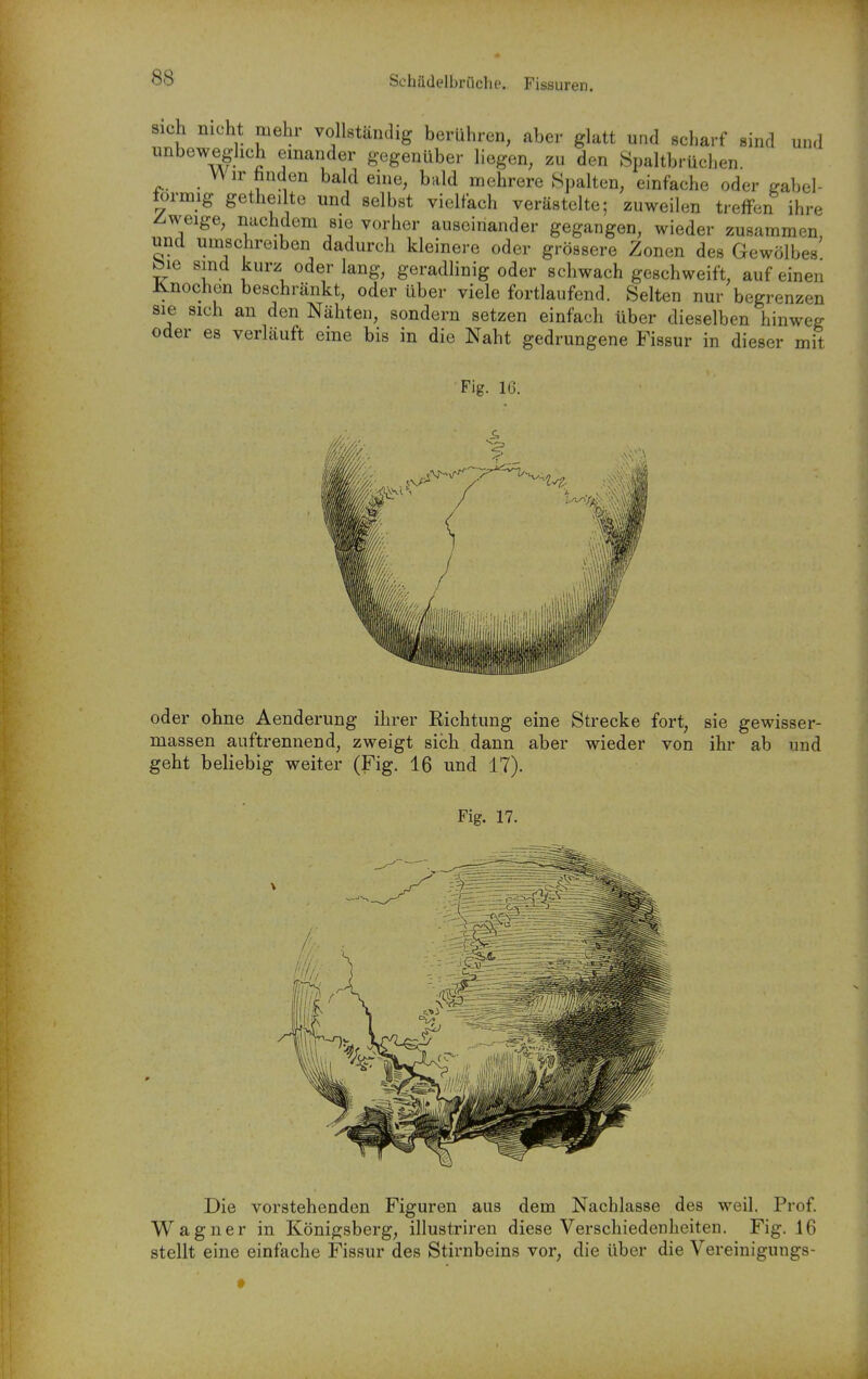 Schädelbrüche. Fissuren. Sich mcht mehr vollständig berühren, aber glatt und scharf sind und unbeweglich einander gegenüber liegen, zu den 8paltbrüchen. Wir finden bald eine, bald mehrere Spalten, einfache oder gabel- förmig getheilte und selbst vielfach verästelte; zuweilen treffen ihre Z-weige, nachdem sie vorher auseinander gegangen, wieder zusammen und umschreiben dadurch kleinere oder grössere Zonen des Gewölbes bie sind kurz oder lang, geradlinig oder schwach geschweift, auf einen Knochen beschränkt, oder über viele fortlaufend. Selten nur begrenzen sie sich an den Nähten, sondern setzen einfach über dieselben hinweg oder es verläuft eine bis in die Naht gedrungene Fissur in dieser mit Fig. 16. oder ohne Aenderung ihrer Richtung eine Strecke fort, sie gewisser- massen auftrennend, zweigt sich dann aber wieder von ihr ab und geht beliebig weiter (Fig. 16 und 17). Fig. 17. Die vorstehenden Figuren aus dem Nachlasse des weil. Prof. Wagner in Königsberg, illustriren diese Verschiedenheiten. Fig. 16 stellt eine einfache Fissur des Stirnbeins vor, die über die Vereinigungs-