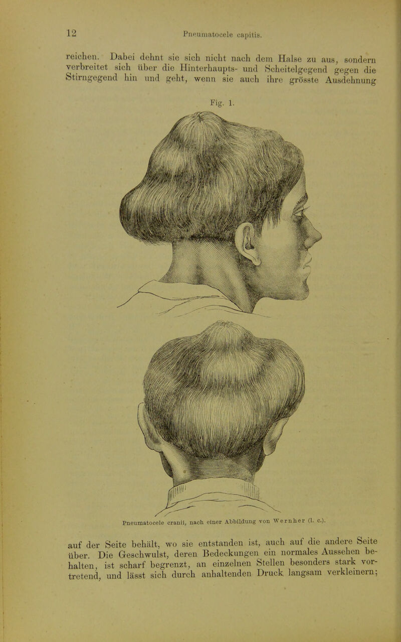 reichen. Dabei dehnt sie sich nicht nach dem Halse zu aus, sondern verbreitet sich über die Hinterhaupts- und Scheitelgegend gegen die Stirngegeud hin und geht, wenn sie auch ihre grösste Ausdehnung Fig. 1. Pneumatocele cranii, nach einer Abbildung von Wernher (1. c). auf der Seite behält, wo sie entstanden ist, auch auf die andere Seite über. Die Geschwulst, deren Bedeckungen ein normales Aussehen be- halten, ist scharf begrenzt, an einzelnen Stellen besonders stark vor- tretend, und lässt sich durch anhaltenden Druck langsam verkleinern;