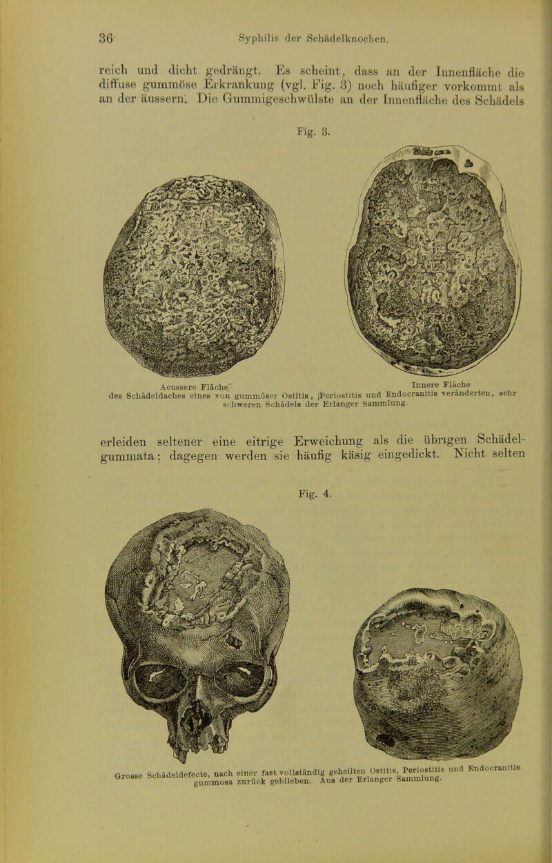 reich und dicht gedrängt. Es scheint, dass an der Innenfläche die diffuse gummöse Erkrankung (vgl. Fig. 3) noch häufiger vorkommt als an der äussern. Die Gummigeschwülste an der Innenfläche des Schädels Fig. 3. Aeussere Fläche' Innere Fläche des Schädeldaches einesvon gummöser Ostitis, jPeriostitis und Endocranitis -veränderten, sehr schweren Schädels der Erlanger Sammlung. erleiden seltener eine eitrige Erweichung als die übrigen Schädel- gummata; dagegen werden sie häufig käsig eingedickt. Nicht selten Fig. 4. Grosse Schädeldefecte, nach einer fast vollständig geheilten Ostitis Periostitis und Endocranitis Grosse Schademeiecte,^^^_^ ^^^.^^ geblieben. Aus der Brianger Sammlung.