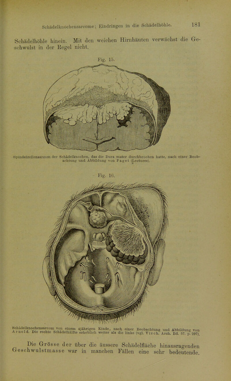 Schädelknochensarcome; Eindringen in die Schädelhöhle. Schädelhöhle hinein. Mit den weichen Hirnhäuten verwächst die Ge- .schwulst in der Regel nicht. Fig. 15. Spindelzellensaroom der Schädelknochen, das die Dura mater durchbrochen hatte, nach einer Beob achtung imd Abbildung von Paget (Lectures). Die Grö sse der über die äussere Schädelfläche hinausragenden Geschwulstmasse war in manchen Fällen eine sehr bedeutende.