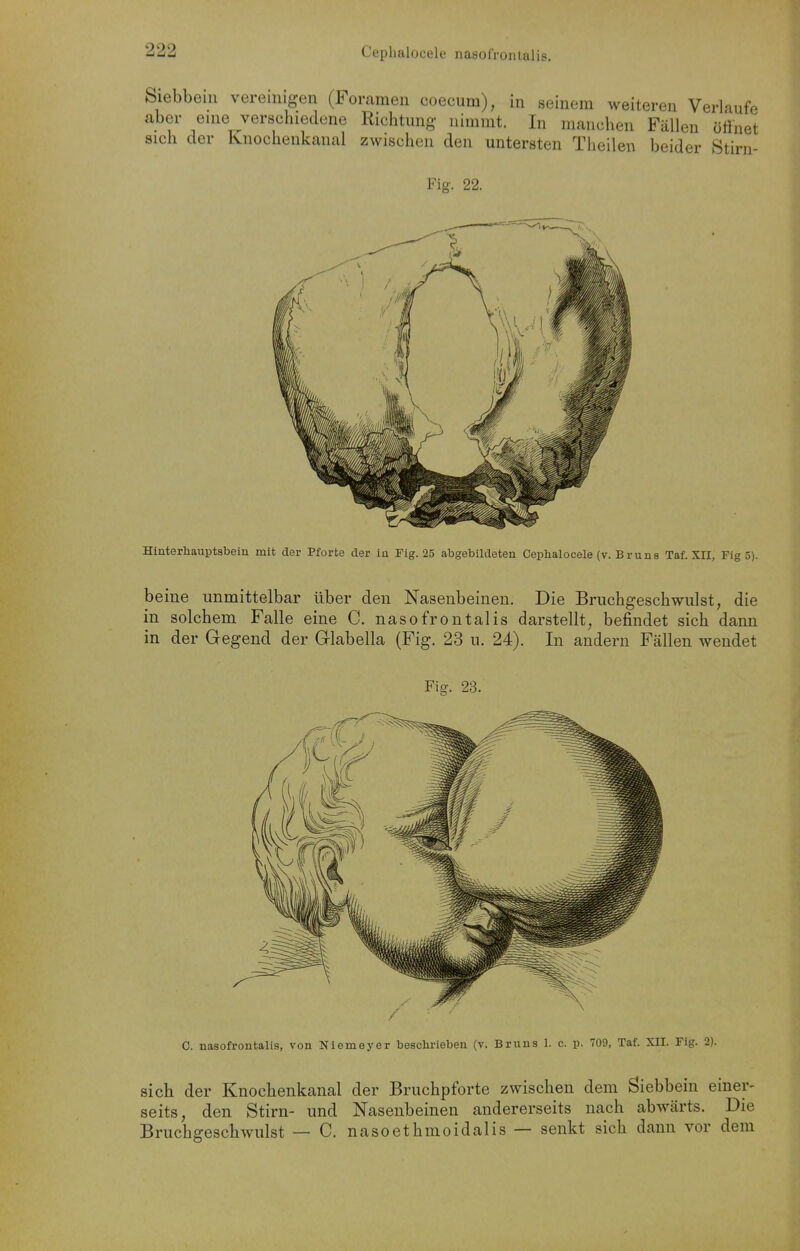 Siebbein vereinigen (Foramen coecum), in seinem weiteren Verlaufe aber eine verschiedene Richtung nimmt. In manchen Fällen üünet sich der Knochenkanal zwischen den untersten Theilen beider Stirn- Fig. 22. Hinterhauptsbein mit der Pforte der in Fig. 25 abgebildeten Cephalocele (v. B r u n s Taf. Xn, Fig 5). beine unmittelbar über den Nasenbeinen. Die Bruchgeschwulst, die in solchem Falle eine C. nasofrontalis darstellt, befindet sich dann in der Gegend der Glabella (Fig. 23 u. 24). In andern Fällen wendet Fig. 23. C. nasofrontalis, von Niemeyer beschi'ieben (v. Bruns 1. c. p. 709, Taf. XII. Flg. 2). sich der Knochenkanal der Bruchpforte zwischen dem Siebbein einer- seits, den Stirn- und Nasenbeinen andererseits nach abwärts. Die Bruchgeschwulst — C. nasoethmoidalis— senkt sich dann vor dem