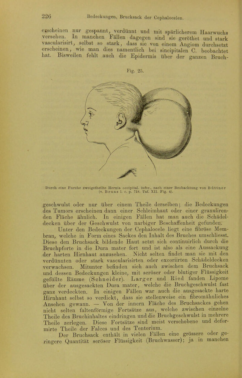 Bedeckungen, Brucksack der Ceplialocelen. erscheinen nur gespannt, verdünnt und mit spärlicherem Haarwuchs versehen. In manchen Fällen dagegen sind sie geröthet und stark vascularisirt, selbst so stark, dass sie von einem Angiom durchsetzt erscheinen, wie man dies namentlich bei sincipitalen C. beobachtet hat. Bisweilen fehlt auch die Epidermis über der ganzen Bruch- Fig. 25. Durch eine Furche zweigethellte Hernia occipital. infer., nach einer Beobachtung von Büttner (v. Bruns 1. c. p. 718. Taf. XII. Fig. 4). geschwulst oder nur über einem Theile derselben; die Bedeckungen des Tumors erscheinen dann einer Schleimhaut oder einer granuliren- den Fläche ähnlich. In einigen Fällen hat man auch die Schädel- decken über der Geschwulst von narbiger Beschaffenheit gefunden. Unter den Bedeckungen der Cephalocele liegt eine fibröse Mem- bran, welche in Form eines Sackes den Inhalt des Bruches umschliesst. Diese den Bruchsack bildende Haut setzt sich continuirlich durch die Bruchpforte in die Dura mater fort und ist also als eine Aussackung der harten Hirnhaut anzusehen. Nicht selten findet man sie mit den verdünnten oder stark vascularisirten oder excoriirten Schädeldecken verwachsen. Mitunter befinden sich auch zwischen dem Bruchsack und dessen Bedeckungen kleine, mit seröser oder blutiger Flüssigkeit gefüllte Räume (Schneider). Larger und Ried fanden Lipome über der ausgesackten Dura mater, welche die Bruchgeschwulst fast ganz verdeckten. In einigen Fällen war auch die ausgesackte harte Hirnhaut selbst so verdickt, dass sie stellenweise ein fibromähnHches Ansehen gewann. — Von der innern Fläche des Bruchsackes gehen nicht selten faltenförmige Fortsätze aus, welche zwischen einzelne Theile des Bruchinhaltes eindringen und die Bruchgeschwulst in mehrere Theile zerlegen. Diese Fortsätze sind meist verschobene und defor- mirte Theile der Falces und des Tentorium. Der Bruchsack enthält in vielen Fällen eine grössere oder ge- ringere Quantität seröser Flüssigkeit (Bruchwasser); ja in manchen