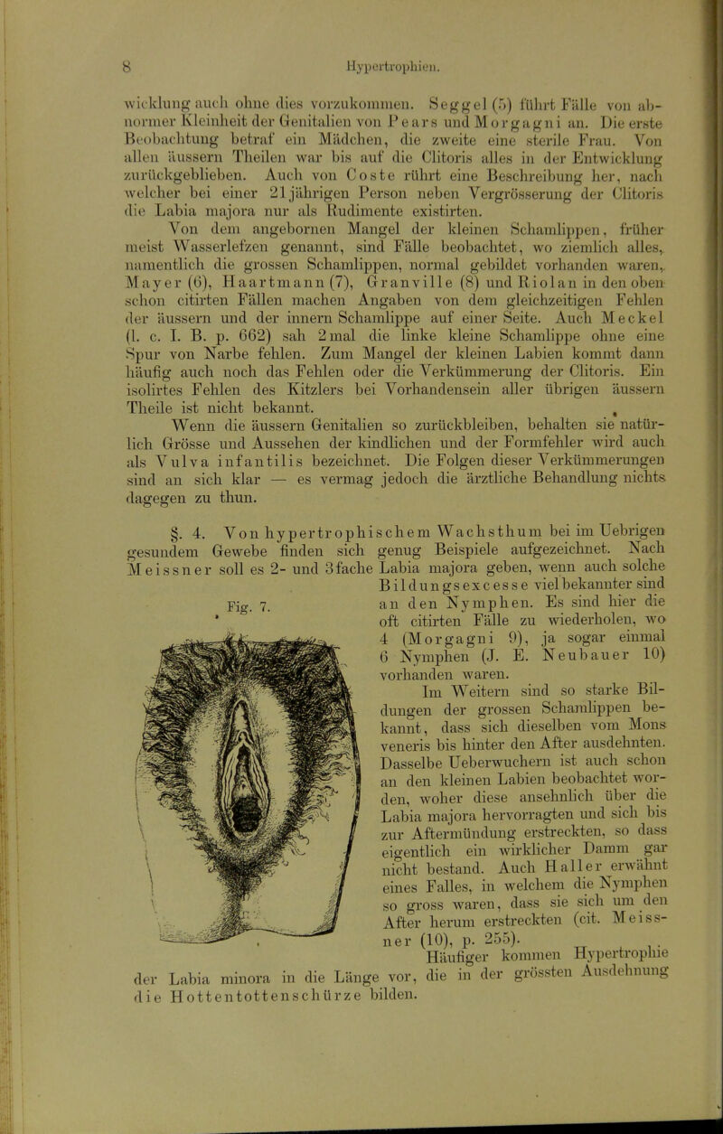 wicklniig auch ohne dies vorzukommen. Seggel(5) führt Fälle von ab- normer Kleinheit der Genitalien von P e a r s und M o r g a g n i an. Die erste Beobachtung betraf ein Mädchen, die zweite eine sterile Frau. Von allen äussern Theilen war bis auf die Clitoris alles in der Entwicklung zurückgeblieben. Auch von Coste rührt eine Beschreibung her, nach welcher bei einer 21jährigen Person neben Vergrösserung der Clitoris die Labia majora nur als Rudimente existirten. Von dem angebornen Mangel der kleinen Schamlippen, früher meist Wasserlefzen genannt, sind Fälle beobachtet, wo ziemlich alles, namentlich die grossen Schamlippen, normal gebildet vorhanden waren,, Mayer (6), Haartmann (7), Granville (8) und Riolan in den oben schon citirten Fällen machen Angaben von dem gleichzeitigen Fehlen der äussern und der innern Schamlippe auf einer Seite. Auch Meckel (1. c. I. B. p. 662) sah 2 mal die linke kleine Schamlippe ohne eine Spur von Narbe fehlen. Zum Mangel der kleinen Labien kommt dann häufig auch noch das Fehlen oder die Verkümmerung der Clitoris. Ein isolirtes Fehlen des Kitzlers bei Vorhandensein aller übrigen äussern Theile ist nicht bekannt. , Wenn die äussern Genitalien so zurückbleiben, behalten sie natür- lich Grösse und Aussehen der kindlichen und der Formfehler wird auch als Vulva infantilis bezeichnet. Die Folgen dieser Verkümmerungen sind an sich klar — es vermag jedoch die ärztliche Behandlung nichts dagegen zu thun. §. 4. Von hypertrophischem Wachsthum bei im Uebrigen gesundem Gewebe finden sich genug Beispiele aufgezeichnet. Nach Meissner soll es 2- und 3fache Labia majora geben, wenn auch solche Bildungsexcesse viel bekannter sind an den Nymphen. Es sind hier die oft citirten Fälle zu wiederholen, wo 4 (Morgagni 9), ja sogar einmal 6 Nymphen (J. E. Neubauer 10) vorhanden waren. Ln Weitern sind so starke Bil- dungen der grossen Schamlippen be- kannt, dass sich dieselben vom Möns veneris bis hinter den After ausdehnten. Dasselbe Ueberwuchern ist auch schon an den kleinen Labien beobachtet wor- den, woher diese ansehnhch über die Labia majora hervorragten und sich bis zur Aftermündung erstreckten, so dass eigenthch ein wirklicher Damm gar nicht bestand. Auch Hall er erwähnt eines Falles, in welchem die Nymphen so gross waren, dass sie sich um den After herum erstreckten (cit. Meiss- ner (10), p. 255). Häufiger kommen Hypertrophie der Labia minora in die Länge vor, die in der grössten Ausdehnung die Hottentottenschürze bilden. Fig. 7.