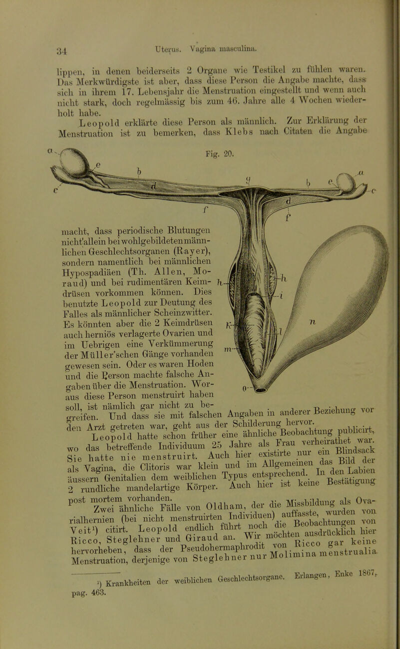 lippen, in denen beiderseits 2 Organe wie Testikel zu fühlen waren. Das Merkwürdigste ist aber, dass diese Person die Angabe machte, dass sich in ihrem 17. Lebensjahr die Menstruation eingestellt und wenn auch nicht stark, doch regelmässig bis zum 4G. Jahre alle 4 Wochen wieder- holt habe. „ , i i Leopold erklärte diese Person als männlich. Zur Erklärung der Menstruation ist zu bemerken, dass Klebs nach Citaten die Angabe Fig. 20. macht, dass periodische Blutungen nicht allein bei wohlgebildetenmänn- lichen Geschlechtsorganen (R a y e r), sondern namentlich bei männlichen Hypospadiäen (Th. Allen, Mo- raud) und bei rudimentären Keim- drüsen vorkommen können. Dies benutzte Leopold zur Deutung des Falles als männlicher Scheinzwitter. Es könnten aber die 2 Keimdrüsen auch herniös verlagerte Ovarien und im üebrigen eine Verkümmerung der Müller'schen Gänge vorhanden gewesen sein. Oder es waren Hoden und die ßerson machte falsche An- gaben über die Menstruation. Wor- aus diese Person menstruirt haben Ärsif^it felscten Angaben in andere. Begehung vor Am Arzt 2-etreten war, geht aus der Schilderung hervor. Leorold hatte s'chon früher eine ätoHche Beobach ung pu^^^^^^^^ wo das betreffende Individuum 25 Jahre als Frau ^'^i'«' I°e hatte nie menstruirt. Auch hier existirte nur ^in BM^k als Vagina, die Clitoris waa- klein und i-» Allgememen das Bdd te äussern örfahen dem weibhchen Typus entsprechend. Lab.^^^^ 2 rundliche mandelartige Korper. Auch te ist kerne Bestätigung TwIrÄ me von Oldham, der die ^^^^^'^Z rialhernien. (bei nicht --struirten M^^^^^^^^ Z Veit') citirt. Leopold X' g'^terausdrUckto hier Ricco, Steglehner und Giraud an. „^r keine hervorheben, dass der P«<if°h^™X;nuUolim^^r^^^^ Menstruation, derjemge von Steglehnei nui moumi ^K^^Bkheiten der weiblichen Geaehlecht.<,rgane. Ertogen. Enke 1867, pag. 463.