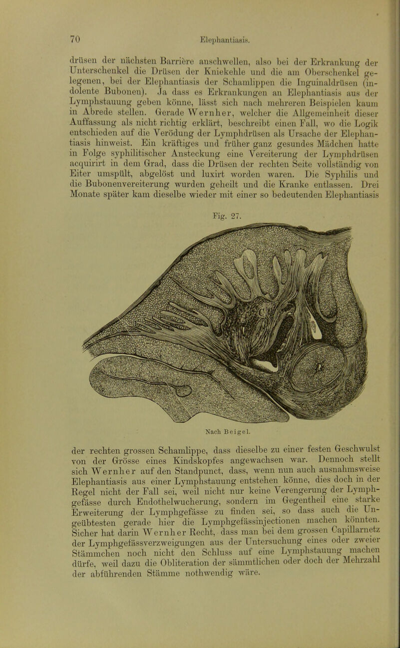 drüsen der nächsten Barriere anschwellen, also bei der Erkrankung der Unterschenkel die Drüsen der Kniekehle und die am Oberschenkel ge- legenen, bei der Elephantiasis der Schamlippen die Inguinaldrüsen (in- dolente Bubonen). Ja dass es Erkrankungen an Elephantiasis aus der Lymphstauung geben könne, lässt sich nach mehreren Beispielen kaum in Abrede stellen. Gerade Wernher, welcher die Allgemeinheit dieser Auffassung als nicht richtig erklärt, beschreibt einen Fall, wo die Logik entschieden auf die Verödung der Lymphdrüsen als Ursache der Elephan- tiasis hinweist. Ein kräftiges und früher ganz gesundes Mädchen hatte in Folge syphilitischer Ansteckung eine Vereiterung der Lymphdrüsen acquirii-t in dem Grad, dass die Drüsen der rechten Seite vollständig von Eiter umspült, abgelöst und luxirt worden waren. Die Syphilis und die Bubonenvereiterung wurden geheilt und die Kranke entlassen. Drei Monate später kam dieselbe wieder mit einer so bedeutenden Elephantiasis Fig. 27. Nach Beigel. der rechten grossen Schamlippe, dass dieselbe zu einer festen Geschwulst von der Grösse eines Kindskopfes angewachsen war. Dennoch stellt sich Wernher auf den Standpunct, dass, wenn nun auch ausnahmsweise Elephantiasis aus einer Lymphstauung entstehen könne, dies doch in der Regel nicht der Fall sei, weil nicht nur keine Verengerung der Lymph- gefässe durch Endothelwucherung, sondern im Gegentheil eine starke Erweiterung der Lymphgefässe zu finden sei, so dass auch die Un- geübtesten gerade hier die Lymphgefässinjectionen machen könnten. Sicher hat darin Wernher Recht, dass man bei dem grossen Capillarnetz der Lymphgefässverzweigungen aus der Untersuchung eines oder zweier Stämmchen noch nicht den Sclüuss auf eine Lymphstauung machen dürfe, weü dazu die Obliteration der sämmtlichen oder doch der Melii'zahl der abführenden Stämme nothAvendig wäre.