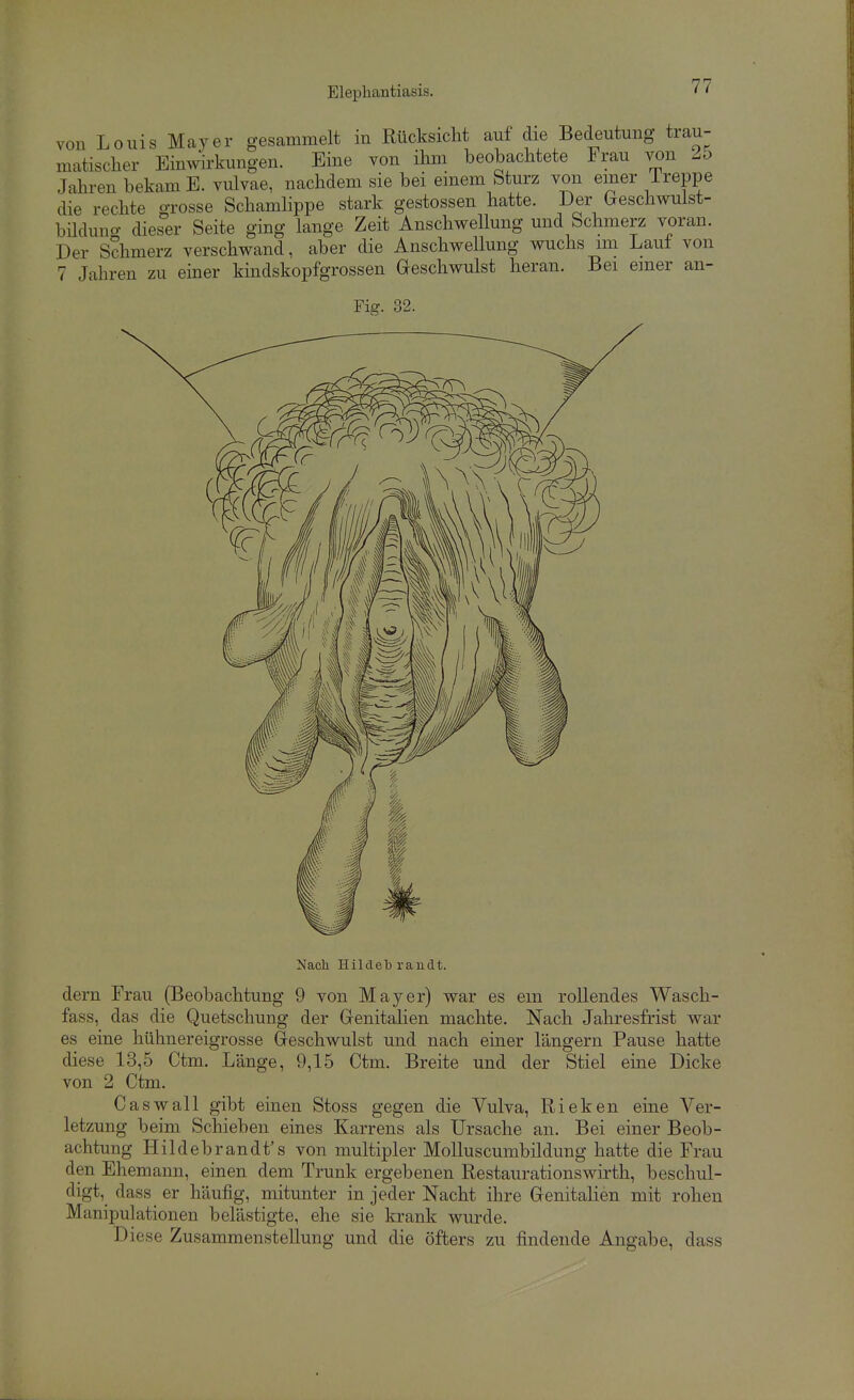 von Louis Mayer gesammelt in Rücksicht auf die Bedeutung trau- matischer Einwirkungen. Eine von ihm beobachtete Frau wn 25 Jahren bekam E. vulvae, nachdem sie bei einem Sturz von einer Treppe die rechte grosse Schamlippe stark gestossen hatte. Der Geschwuist- büduno- dieser Seite ging lange Zeit Anschwellung und Schmerz voran. Der Schmerz verschwand, aber die Anschwellung wuchs im Laut von 7 Jahren zu einer kindskopfgrossen Geschwulst heran. Bei einer an- Fig. 32. Nach Hildebrandt. dern Frau (Beobachtung 9 von Mayer) war es em rollendes Wasch- fass, das die Quetschung der Genitalien machte. Nach Jahresfrist war es eine hühnereigrosse Geschwulst und nach einer längern Pause hatte diese 13,5 Ctm. Länge, 9,15 Ctm. Breite und der Stiel eine Dicke von 2 Ctm. Gas wall gibt einen Stoss gegen die Vulva, Rieken eine Ver- letzung beim Schieben eines Karrens als Ursache an. Bei einer Beob- achtung Hildebrandt's von multipler Molluscumbildung hatte die Frau den Ehemann, einen dem Trunk ergebenen Restaurationswirth, beschul- digt, dass er häufig, mitunter in jeder Nacht ihre Genitalien mit rohen Manipulationen belästigte, ehe sie krank wurde. Diese Zusammenstellung und die öfters zu findende Angabe, dass