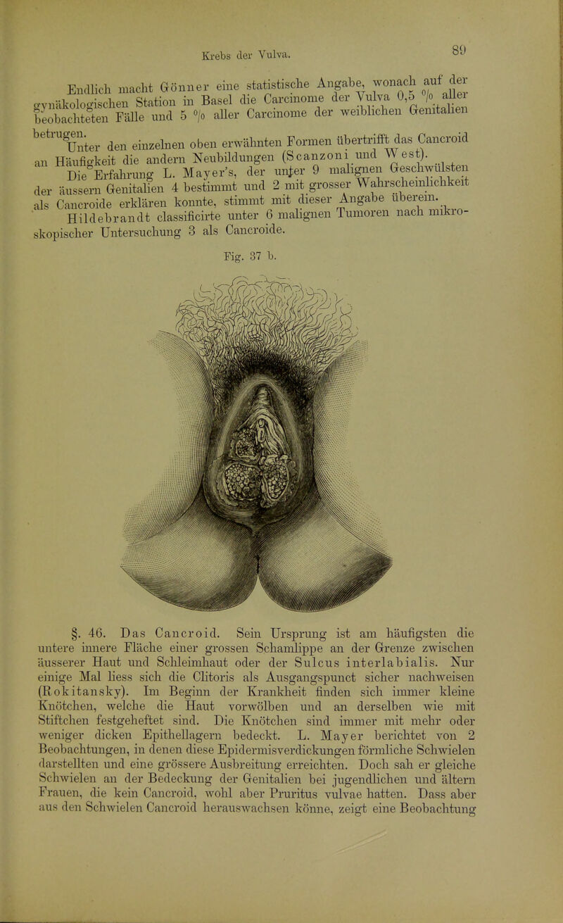 Endlich macht Gönner eine statistische Angabe^ wonach auf dei gynäkologischen Station in Basel die Carcmome der Vulva 0,5 > aUer beobachteten Fälle und 5 > aUer Carcmome der weibhchen Genitahen Unter den einzehien oben erwähnten Formen übertrifft das Cancroid an Häufigkeit die andern Neubüdmigen (Scanzoni und West). Die Erfahrung L. Mayers, der un^er 9 malignen Geschwulsten der äussern Genita&n 4 bestimmt und 2 mit grosser Wahrscheinlichkeit als Cancroide erklären konnte, stimmt mit dieser Angabe uberem. Hildebrandt classificirte unter 6 malignen Tumoren nach mikro- skopischer Untersuchung 3 als Cancroide. Fig. 37 b. §. 46. Das Cancroid. Sein Ursprung ist am häufigsten die untere innere Fläche einer grossen Schamlippe an der Grenze zwischen äusserer Haut und Sclileimhaut oder der Sulcus interlabialis. Nur einige Mal liess sich die Clitoris als Ausgangspunct sicher nachweisen (Rokitansky). Im Beginn der Krankheit finden sich immer kleine Knötchen, welche die Haut vorwölben und an derselben wie mit Stiftchen festgeheftet sind. Die Knötchen sind immer mit mehr oder weniger dicken Epithellagern bedeckt. L. Mayer berichtet von 2 Beobachtungen, in denen diese Epidermisverdickungen förmliche Schwielen darstellten und eine grössere Ausbreitung erreichten. Doch sah er gleiche Schwielen an der Bedeckung der Genitalien bei jugendlichen und altern Frauen, die kein Cancroid, wohl aber Pruritus vulvae hatten. Dass aber aus den Schwielen Cancroid herauswachsen könne, zeigt eine Beobachtung