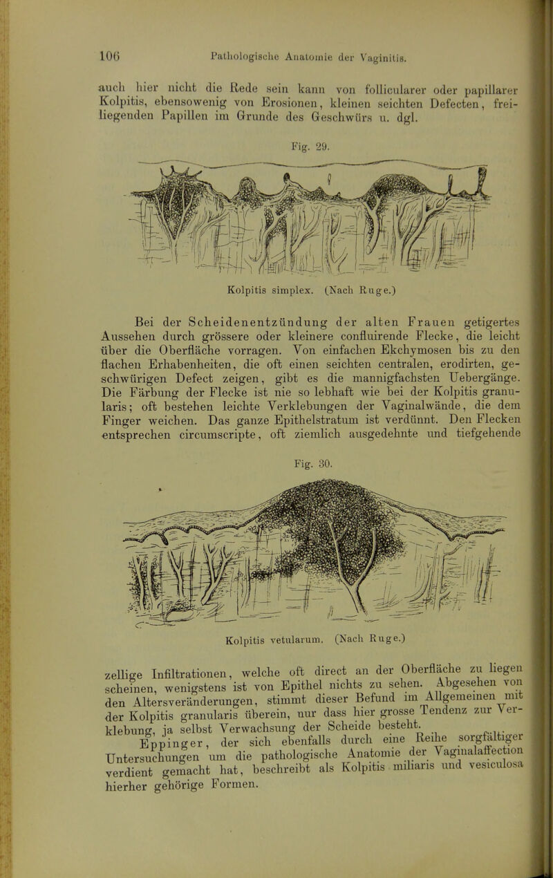 auch hier nicht die Rede sein kann von follicularer oder papillärer Kolpitis, ebensowenig von Erosionen, kleinen seichten Defecten, frei- liegenden Papillen im Grunde des Geschwürs u. dgl. Fig. 29. Kolpitis Simplex. (Nach Rüge.) Bei der Scheidenentzündung der alten Frauen getigertes Aussehen durch grössere oder kleinere confluirende Flecke, die leicht über die Oberfläche vorragen. Von einfachen Ekchymosen bis zu den flachen Erhabenheiten, die oft einen seichten centralen, erodirten, ge- schwürigen Defect zeigen, gibt es die mannigfachsten Uebergänge. Die Färbung der Flecke ist nie so lebhaft wie bei der Kolpitis granu- laris; oft bestehen leichte Verklebungen der Vaginalwände, die dem Finger weichen. Das ganze Epithelstratum ist verdünnt. Den Flecken entsprechen circumscripte, oft ziemlich ausgedehnte und tiefgehende Fig. 30. Kolpitis vetularum. (Nach Rüge.) zellige Infiltrationen, welche oft direct an der Oberfläche zu hegen scheinen, wenigstens ist von Epithel nichts zu sehen. Abgesehen von den Altersveränderungen, stimmt dieser Befund nn Allgememen mit der Kolpitis granularis überein, nur dass hier grosse Tendenz zur Ver- klebung, ia selbst Verwachsung der Scheide besteht. Eppinger, der sich ebenfalls durch eme Reihe sorgfaltiger TJntersuchunlen um die pathologische Anatomie der Vaginalaffec lon verdient gemacht hat, beschreibt als Kolpitis miharis und vesiculosa hierher gehörige Formen.