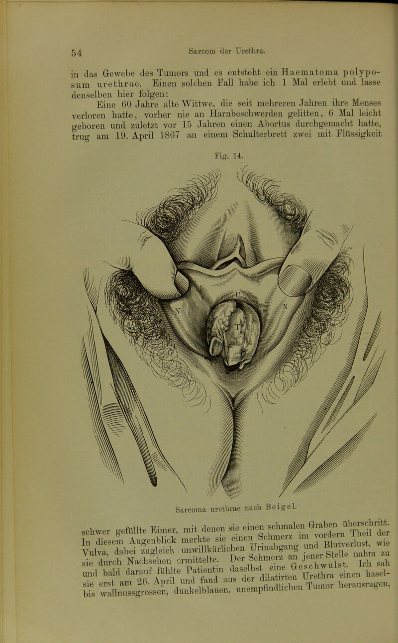 in das Gewebe des Tumors und es entsteht einHaematoma polypo- sum urethrae. Einen solchen Fall habe ich 1 Mal erlebt und lasse denselben hier folgen: Eine 60 Jalii-e alte Wittwe, die seit mehreren Jahren ihre Menses verloren hatte, vorher nie an Harnbeschwerden gelitten, 6 Mal leicht geboren und zuletzt vor 15 Jahren einen Abortus durchgemacht hatte, trug am 19. April 18G7 an einem Schulterbrett zwei mit Flüssigkeit Fig. 14. Sarcoma uretlirae nach Beigel. schwer gefüllte Eimer, mit denen sie einen schmalen 6™«^c^^ In lesem Angenblick merkte sie einen Schmerz un ™rton The 1 dei raWda.rau„n^^^^^^^^^^ Sie erst am ^o. Apiu unu iduu a „^„^„Jl^pbpn Tumor herausragen, bis wallnussgrossen, dunkelblauen, unemphndüclien iumor o