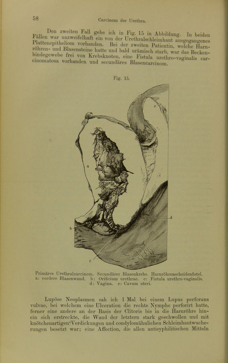 Fnllpn ^^^^11 gebe ich in Fig. 15 in Abbildung. In beiden FaUen war unzweifelhaft ein von der Urethralsclileimhaut ausgeganlnes Swt'r vorhanden. Bei der zweiten Patientin, welcheTa^n- rohren- und Blasensteme hatte und bald urämisch starb, ^ar das Becken- bindegewebe frei von Krebsknoten, eine Fistula uretlli-o-vaginaUs car- cinomatosa vorhanden und secundäres Blasencarcinom. Primäres Urethralcarcinom. a: vordere Blasenwand, b: d: Secundärer Blasenkrebs. HarnröhrensclieidenfisteL Orificium urethrae. c: Fistula urethro-vaginalis. Vagina, e: Cavum uteri. Lupöse Neoplasmen sah ich 1 Mal bei einem Lupus perforans vulvae, bei welchem eine Ulceration die rechte Nymphe perforirt hatte, ferner eine andere an der Basis der Clitoris bis in die Harnröhre hin- ein sich erstreckte, die Wand der letztern stark geschwollen und mit knötchenartigenl^'Verdickungen und condylomähnlicheii Schleimhautwuclie- rungen besetzt war; eine Affection, die allen antisyphilitischen Mitteln