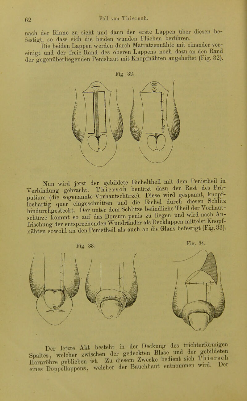 nach der Rinne zu sieht und dann der erste Lappen über diesen be- festigt, so dass sich die beiden wunden Flächen berühren. Die beiden Lappen werden durch Matratzennähte mit einander ver- einigt und der freie Rand des oberen Lappens noch dazu an den Rand der gegenüberliegenden Penishaut mit Knopfnähten angeheftet (Fig. 32). Nun wird jetzt der gebildete Eicheltheil mit dem Penistheil in Verbindung gebracht. Thiersch benützt dazu den Rest des Prä- putium (die sogenannte Vorhautschürze). Diese wird gespannt, knopt- lochartig quer eingeschnitten und die Eichel durch diesen Schlitz hindurchgesteckt. Der unter dem Schlitze befindliche Theil der Vorhaut- schürze kommt so auf das Dorsum penis zu liegen und wird nach An- frischung der entsprechenden Wundränder als Decklappen mittelst Knopt- nähten sowohl an den Penistheil als auch an die Glans befestigt (*ig.dd). Fig. 33. Fig. 34. Der letzte Akt besteht in der Deckung des trichterförmigen Spaltes, welcher zwischen der gedeckten Blase.und der ,gebildeten Harnröhre geblieben ist. Zu diesem Zwecke bedient sich Thieisch eines Doppellappens, welcher der Bauchhaut entnommen wird. Der