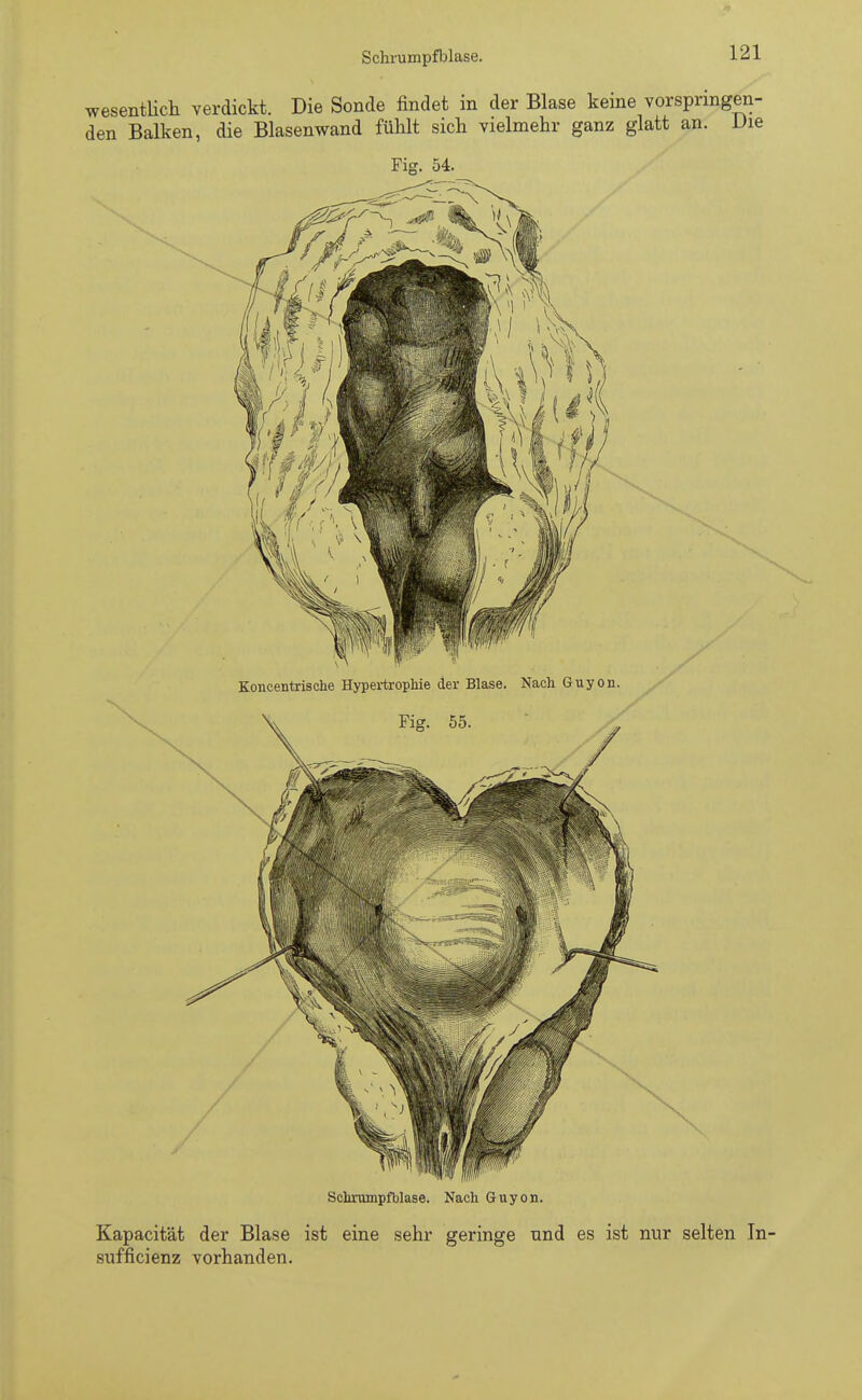 Schrumpfblase. wesentlich verdickt. Die Sonde findet in der Blase keine vorspringen- den Balken, die Blasenwand fühlt sich vielmehr ganz glatt an. Die Fig. 54. Koncentrische Hypertrophie der Blase. Nach Guyon. Schrumpfblase. Nach Guyon. Kapacität der Blase ist eine sehr geringe und es ist nur selten In- sufficienz vorhanden.