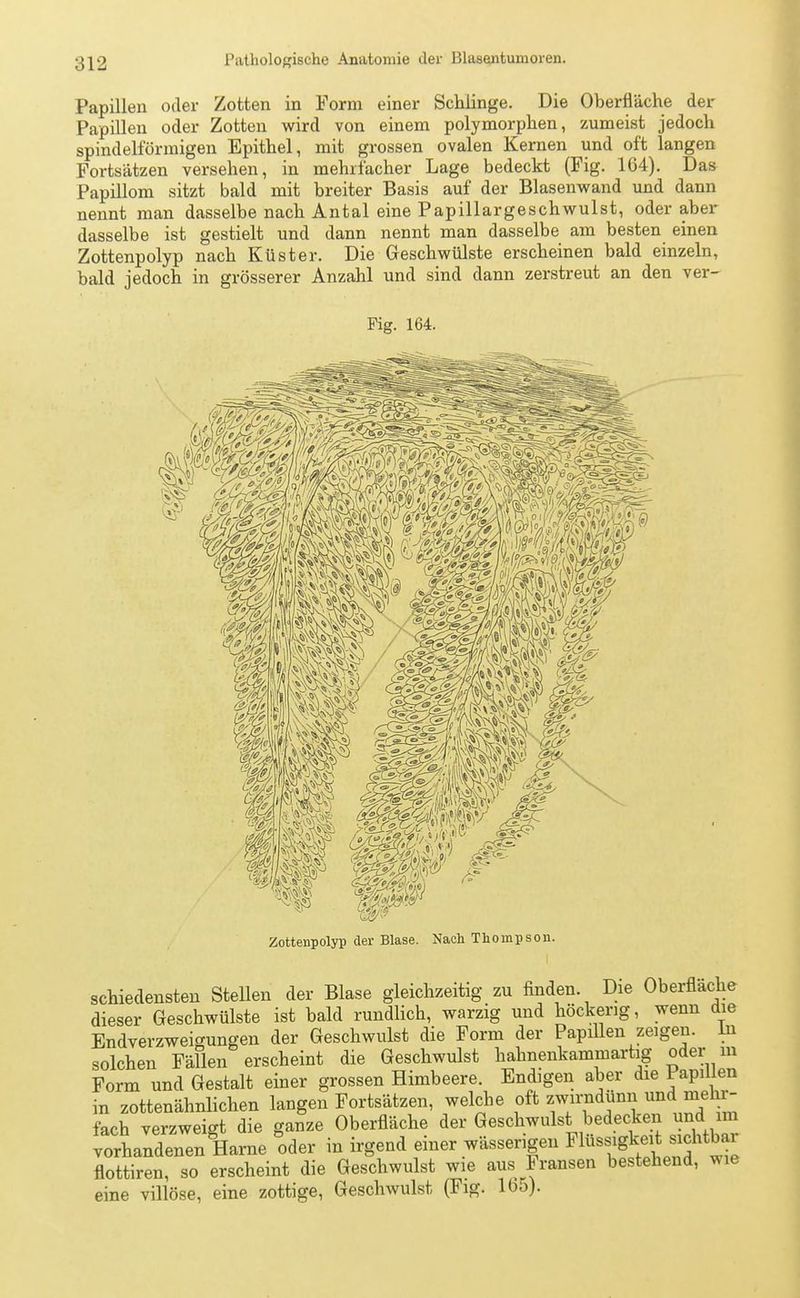 Papillen oder Zotten in Form einer Schlinge. Die Oberfläche der Papillen oder Zotten wird von einem polymorphen, zumeist jedoch spindelförmigen Epithel, mit grossen ovalen Kernen und oft langen Fortsätzen versehen, in mehrfacher Lage bedeckt (Fig. 164). Das Papillom sitzt bald mit breiter Basis auf der Blasenwand und dann nennt man dasselbe nach Antal eine Papillargeschwulst, oder aber dasselbe ist gestielt und dann nennt man dasselbe am besten einen Zottenpolyp nach Küster. Die Geschwülste erscheinen bald einzeln, bald jedoch in grösserer Anzahl und sind dann zerstreut an den ver- Fig. 164. Zottenpolyp der Blase. Nach Thompson. schiedensten Stellen der Blase gleichzeitig zu finden. Die Oberfläche dieser Geschwülste ist bald rundlich, warzig und höckerig, wenn die Endverzweigungen der Geschwulst die Form der Papillen zeigen. In solchen Fällen erscheint die Geschwulst hahnenkammartig oder in Form und Gestalt einer grossen Himbeere. Endigen aber die Papillen in zottenähnlichen langen Fortsätzen, welche oft zwirndünn und mehr- fach Verzweigt die ganze Oberfläche der Geschwulst bedecken und im vorLndenWengHarne oder in irgend einer wässerigen Flüssigkeit sichtbar flottiren, so erscheint die Geschwulst wie aus Fransen bestehend, wie eine villöse, eine zottige, Geschwulst (Fig. 165).