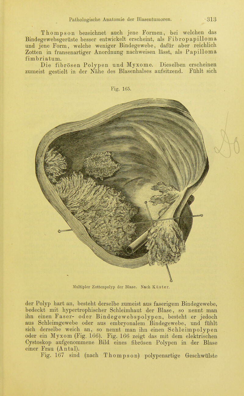 Thompson bezeichnet auch jene Formen, bei welchen das Bindegewebsgerüste besser entwickelt erscheint, als Fibropapilloma und jene Form, welche weniger Bindegewebe, dafür aber reichlich Zotten in fransenartiger Anordnung nachweisen lässt, als Papilloma fimbriatum. Die fibrösen Polypen und Myxome. Dieselben erscheinen zumeist gestielt in der Nähe des Blasenhalses aufsitzend. Fühlt sich Fig. 165. Multipler Zottenpolyp der Blase. Nach Küster. der Polyp hart an, besteht derselbe zumeist aus faserigem Bindegewebe, bedeckt mit hypertrophischer Schleimhaut der Blase, so nennt man ihn einen Faser- oder Bindegewebspolypen, besteht er jedoch aus Schleimgewebe oder aus embryonalem Bindegewebe, und fühlt sich derselbe weich an, so nennt man ihn einen Schleimpolypen oder ein Myxom (Fig. 166). Fig. 166 zeigt das mit dem elektrischen Cystoskop aufgenommene Bild eines fibrösen Polypen in der Blase einer Frau (Antal). Fig. 167 sind (nach Thompson) polypenartige Geschwülste