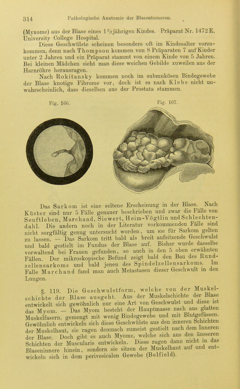 (Myxome) aus der Blase eines 1 x/ajährigen Kindes. Präparat Nr. 1472 E, University College Hospital. Diese Geschwülste scheinen besonders oft im Kindesalter vorzu- kommen, denn nach Thompson kommen von 8 Präparaten 7 auf Kinder unter 2 Jahren und ein Präparat stammt von einem Kinde von 5 Jahren. Bei kleinen Mädchen sieht man diese weichen Gebilde zuweilen aus der Harnröhre herausragen. Nach Rokitansky kommen noch im submukösen Bindegewebe der Blase knotige Fibrome vor, doch ist es nach Klebs nicht un- wahrscheinlich, dass dieselben aus der Prostata stammen. Das Sarkom ist eine seltene Erscheinung in der Blase. Nach Küster sind nur 5 Fälle genauer beschrieben und zwar die Fälle von Senftieben, Marchand, Siewert, Heim-Vögtlin und Schlechten- dahl. Die andern noch in der Literatur vorkommenden Fälle sind nicht sorgfältig genug untersucht worden, um sie für Sarkom gelten zu lassen. — Das Sarkom tritt bald als breit aufsitzende Geschwulst und bald gestielt im Fundus der Blase auf. Bisher wurde dasselbe vorwaltend bei Frauen gefunden, so auch in den 5 oben erwähnten Fällen. Der mikroskopische Befund zeigt bald den Bau des Kund- zellensarkoms und bald jenen des Spindelzellensarkoms. Im Falle Marchand fand man auch Metastasen dieser Geschwult m den Lungen. S 119. Die Geschwulstform, welche von der Muskel- schichte der Blase ausgeht. Aus der Muskelschichte der Blase entwickelt sich gewöhnlich nur eine Art von Geschwulst und diese ist das Myom — Das Myom besteht der Hauptmasse nach aus glatten Muskelfasern, gemengt mit wenig Bindegewebe und mit Blutgefässen. Gewöhnlich entwickeln sich diese Geschwülste aus den inneren Schichten der Muskelhaut, sie ragen demnach zumeist gestielt nach dem inneren der Blase Doch gibt es auch Myome, welche sich aus den äusseren Schichten der Muscularis entwickeln. Diese ragen dann nicht in das Blaseninnere hinein, sondern sie sitzen der Muskelhaut auf und ent- wickeln sich in dem perivesicalen Gewebe (Belfield).