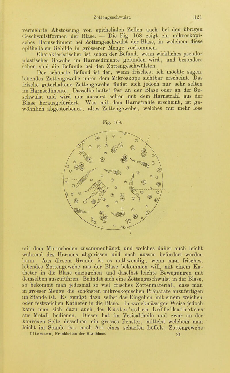 vermehrte Abstossung von epithelialen Zellen auch bei den übrigen Geschwulstformen der Blase. — Die Fig. 168 zeigt ein mikroskopi- sches Harnsediment bei Zottengeschwulst der Blase, in welchem diese epithelialen Gebilde in grösserer Menge vorkommen. Charakteristischer ist schon der Befund, wenn wirkliches pseudo- plastisches Gewebe im Harnsedimente gefunden wird, und besonders schön sind die Befunde bei den Zottengeschwülsten. Der schönste Befund ist der, wenn frisches, ich möchte sagen, lebendes Zottengewebe unter dem Mikroskope sichtbar erscheint. Das irische guterhaltene Zottengewebe findet sich jedoch nur sehr selten im Harnsedimente. Dasselbe haftet fest an der Blase oder an der Ge- schwulst und wird nur äusserst selten mit dem Harnstrahl aus der Blase herausgefördert. Was mit dem Harnstrahle erscheint, ist ge- wöhnlich abgestorbenes, altes Zottengewebe, welches nur mehr lose Fig. 168. mit dem Mutterboden zusammenhängt und welches daher auch leicht während des Harnens abgerissen und nach aussen befördert werden kann. Aus diesem Grunde ist es nothwendig, wenn man frisches, lebendes Zottengewebe aus der Blase bekommen will, mit einem Ka- theter in die Blase einzugehen und daselbst leichte Bewegungen mit demselben auszuführen. Befindet sich eine Zottengeschwulst in der Blase, so bekommt man jedesmal so viel frisches Zottenmaterial, dass man in grosser Menge die schönsten mikroskopischen Präparate anzufertigen im Stande ist. Es genügt dazu selbst das Eingehen mit einem weichen oder festweichen Katheter in die Blase. In zweckmässiger Weise jedoch kann man sich dazu auch, des Küster'schen Löffelkatheters aus Metall bedienen. Dieser hat im Vesicaltheile und zwar an der konvexen Seite desselben ein grosses Fenster, mittelst welchem man leicht im Stande ist, nach Art eines scharfen Löffels, Zottengewebe Ultzmann, Krankheiten der Harnblase. 21