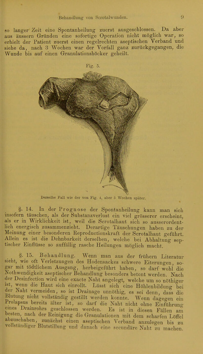 so langer Zeit eine Spontanheilung zuerst ausgeschlossen. Da aber aus äussern Gründen eine sofortige Operation nicht möglich war, so erhielt der Patient zuerst einen regelrechten aseptischen Verband und siehe da, nach 3 Wochen war der Vorfall ganz zurückgegangen, die Wunde bis auf einen Granulationshöcker geheilt. Fig. 5. Derselbe Fall wie der von Fig. 1, aber 3 Wochen später. §.14. In der Prognose der Spontanheilung kann man sich insofern täuschen, als der Substanzverlust ein viel grösserer erscheint, als er in Wirklichkeit ist, weil die Scrotalhaut sich so ausserordent- lich energisch zusammenzieht. Derartige Täuschungen haben zu der Meinung einer besonderen Reproductionskraft der Scrotalhaut geführt. Allein es ist die Dehnbarkeit derselben, welche bei Abhaltung sep- tischer Einflüsse so auffällig rasche Heilungen möglich macht. §.15. Behandlung. Wenn man aus der frühern Literatur sieht, wie oft Verletzungen des Hodensackes schwere Eiterungen, so- gar mit tödtlichem Ausgang, herbeigeführt haben, so darf wohl die Nothwendigkeit aseptischer Behandlung besonders betont werden. Nach der Desinfection wird eine exacte Naht angelegt, welche um so nöthiger ist, wenn die Haut sich einrollt. Lässt sich eine Höhlenbildung bei der Naht vermeiden, so ist Drainage unnöthig, es sei denn, dass die Blutung nicht vollständig gestillt werden konnte. Wenn dageo-en ein Prolapsus bereits älter ist, so darf die Naht nicht ohne Einführun- eines Dramrohrs geschlossen werden. Es ist in diesen Fällen am besten nach der Reinigung die Granulationen mit dem scharfen LöflFel abzuschaben, zunächst einen aseptischen Verband anzulegen bis zu vollstand>ger Blutstillung und danach eine secundäre Naht zu machen