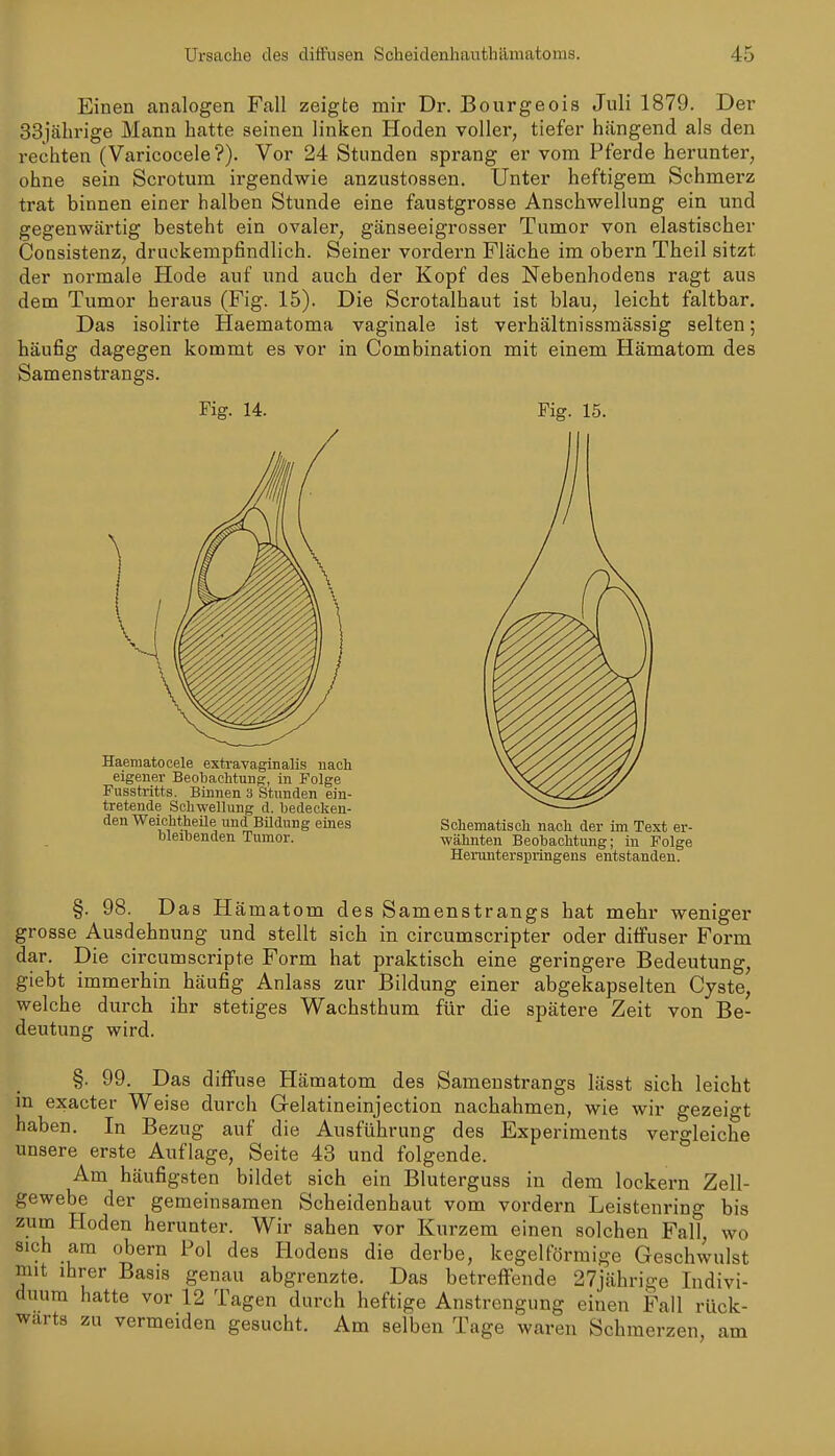 Einen analogen Fall zeigte mir Dr. Bourgeois Juli 1879. Der 33jäbrige Mann hatte seineu linken Hoden voller, tiefer hängend als den rechten (Varicocele?). Vor 24 Stunden sprang er vom Pferde herunter, ohne sein Scrotum irgendwie anzustossen. Unter heftigem Schmerz trat binnen einer halben Stunde eine faustgrosse Anschwellung ein und gegenwärtig besteht ein ovaler, gänseeigrosser Tumor von elastischer Consistenz, druckempfindlich. Seiner vordem Fläche im obern Theil sitzt der normale Hode auf und auch der Kopf des Nebenhodens ragt aus dem Tumor heraus (Fig. 15). Die Scrotalhaut ist blau, leicht faltbar. Das isolirte Haematoma vaginale ist verhältnissmässig selten; häufig dagegen kommt es vor in Combination mit einem Hämatom des Samenstrangs. Fig. 14. Fig. 15. Haematocele extravaginalis nach eigener Beobachtung, in Folge Fusstritts. Binnen 3 Stunden ein- tretende Schwellung d. bedecken- den Weichtheile und Bildung eines bleibenden Tumor. Schematisch nach der im Text er- wähnten Beobachtung; in Folge Herunterspringens entstanden. §. 98. Das Hämatom des Samenstrangs hat mehr weniger grosse Ausdehnung und stellt sich in circumscripter oder diffuser Form dar. Die circumscripte Form hat praktisch eine geringere Bedeutung, giebt immerhin häufig Anlass zur Bildung einer abgekapselten Cyste, welche durch ihr stetiges Wachsthum für die spätere Zeit von Be- deutung wird §. 99. Das diffuse Hämatom des Samenstrangs lässt sich leicht in exacter Weise durch Grelatineinjection nachahmen, wie wir gezeigt haben. In Bezug auf die Ausführung des Experiments vergleiche unsere erste Auflage, Seite 43 und folgende. Am häufigsten bildet sich ein Bluterguss in dem lockern Zell- gewebe der gemeinsamen Scheidenhaut vom vordem Leistenring bis zum Hoden herunter. Wir sahen vor Kurzem einen solchen Fall wo sich am obern Pol des Hodens die derbe, kegelförmige Geschwulst mit ihrer Basis genau abgrenzte. Das betreffende 27jährige Indivi- duum hatte vor 12 Tagen durch heftige Anstrengung einen Fall rück- wärts zu vermeiden gesucht. Am selben Tage waren Schmerzen, am