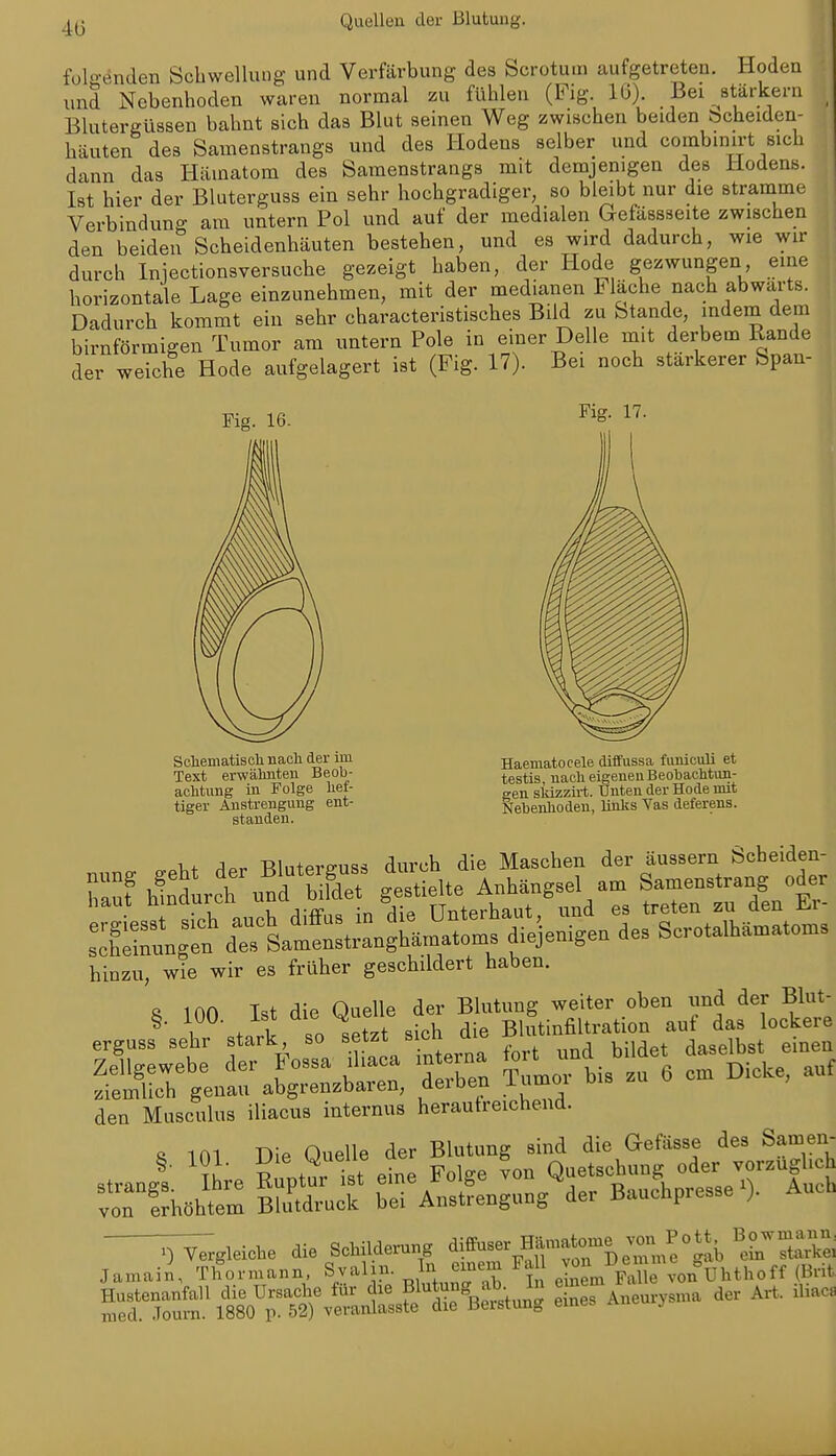 fül•enden Schwellung und Verfärbung des Scrotum aufgetreten. Hoden und Nebenhoden waren normal zu fühlen (Fig. 16) Bei ^stärkern Blutergüssen bahnt sich das Blut seinen Weg zwischen beiden bcheiden- häuten des Samenstrangs und des Hodens selber und combmirt sich dann das Hämatom des Samenstrangs mit demjenigen des Hodens. Ist hier der Bluterguss ein sehr hochgradiger, so bleibt nur die stramme Verbindung am untern Pol und auf der medialen Gefässseite zwischen den beiden Scheidenhäuten bestehen, und es wird dadurch, wie wir durch Iniectionsversuche gezeigt haben, der Hode gezwungen eine horizontale Lage einzunehmen, mit der medianen 1^ lache nach abwärts. Dadurch kommt ein sehr characteristisches Bild zu Stande, indem dem birnförmigen Tumor am untern Pole in einer Delle mit derbem Rande der weiche Hode aufgelagert ist (Fig. 17). Bei noch stärkerer Span- Fig. 16. Fig. 17. Soliematisclinacli der im Text erwälinteu Beob- aolitimg in Folge kef- tiger Anstrenguug ent- standen. Haeniatocele diffussa fumculi et testis, nacli eigenen Beobachtun- gen sldzzirt. Unten der Hode mit Nebenlioden, links Vas deferens. hinzu, wie wir es früher geschildert haben. ft 100 Ist die Ouelle der Blutung weiter oben und der Blut- ^' 1 .t.rk so setzt sich die Blutinfiltration auf das lockere den Musculus iliacus internus herautreichend. 8 im Die Ouelle der Blutung sind die Gefässe des Samen- Hustenanfall die Ursache für die Bl^Ju^ e nes Aneurysma der Art. iliac8 med. .Tourn. 1880 r- 52) veranlasste die Beistung eines ^ j