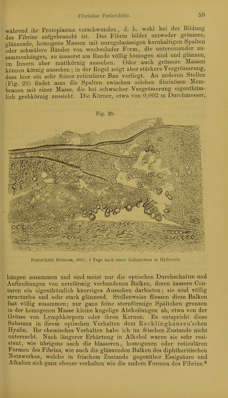während ihr Protoplasma verschwunden, d. h. wohl bei der Bildung des Fibrins aufgebraucht ist. Das Fibrin bildet entweder grössere, o-länzende, homogene Massen mit unregelmässigen kernhaltigen Spalten oder schmälere Bänder von wechselnder Form, die untereinander zu- sammenhängen, zu äusserst am Rande völlig homogen sind und glänzen, im Innern aber mattkörnig aussehen. Oder auch grössere Massen können körnig aussehen ; in der Regel zeigt aber stärkere Vergrösserung, dass hier ein sehr feiner reticulärer Bau vorliegt. An anderen Stellen (Fig. 20) findet man die Spalten zwischen solchen fibrinösen Mem- branen mit einer Masse, die bei schwacher Vergrösserung eigenthüm- lich grobkörnig aussieht. Die Körner, etwa von 0,002 m Durchmesser, Fig. 20. Periorchitis fibrinosa, 30011; 3 Tage naci einer Jodinjectiou in Hydrooele. hängen zusammen und sind meist nur die optischen Durchschnitte und Auftreibungen von netzförmig verbundenen Balken, deren äussere Con- turen ein eigenthümlich knorriges Aussehen darbieten; sie sind völlig structurlos und sehr stark glänzend. Stellenweise fliessen diese Balken fast völlig zusammen; nur ganz feine sternförmige Spältchen grenzen in der homogenen Masse kleine kugelige Abtheilungen ab, etwa von der Grösse von Lymphkörpern oder ihren Kernen. Es entspricht diese Substanz in ihrem optischen Verhalten dem Reckliughausen'schen Hyalin. Ihr chemisches Verhalten habe ich im frischen Zustande nicht untersucht. Nach längerer Erhärtung in Alkohol waren sie sehr resi- stent, wie übrigens auch die blasseren, homogenen oder reticulären Formen des Fibrins, wie auch die glänzenden Balken des diphtheritischen Netzwerkes, welche in frischem Zustande gegenüber Essigsäure und Alkalien sich ganz ebenso verhalten wie die andern Formen des Fibrins.