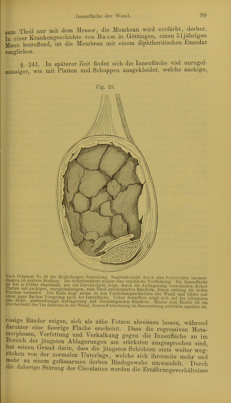 zum Theil nur mit dem Messer, die Membran wird entfärbt, derber. In einer Krankengeschichte von Baum in Göttingen, einen 51jährigen Manu betreffend, ist die Membran mit einem diphtheritischen Exsudat verglichen. §. 241. In späterer Zeit findet sich die Innenfläche viel unregel- mässiger, wie mit Platten und Schuppen ausgekleidet, welche zackige, Fig. 23. J«ach Präparat Nr. 25 der Heidelberger Sammlung. Sagittalsclmitt durch eine Periorchitis haemor- rhagioa im spätem Stadium. Die Scheidenhäute zeigen eine erhehliche Verdickung. Die Innenfläche ist wie in Felder abgetheüt, wie der Durchschnitt zeigt, durch die Auflagerung verschieden dicker platten mit zackigen, um-egelmässigen, zum Theil unterminii-ten Rändern, denen entlang die tiefen * urchen verlaufen. Der Hode liegt unten in den Verdickungsschichten der Wand un(f bildet nur rissige Ränder zeigen, sich als zähe Fetzen abreisseu lassen, während darunter eine faserige Fläche erscheint. Dass die regressiven Meta- morphosen, Verfettung und Verkalkung gegen die Innenfläche zu im iJereich der jüngsten Ablagerungen am stärksten ausgesprochen sind, hat seinen Grund darin, dass die jüngsten Schichten stets weiter weg- rucken von der normalen Unterlage, welche sich ihrerseits mehr und mehr zu einem gefässarmen derben Bindegewebe umwandelt. Durch tlie dahenge Störung der Circulation werden die Ernährungsverhältnisse