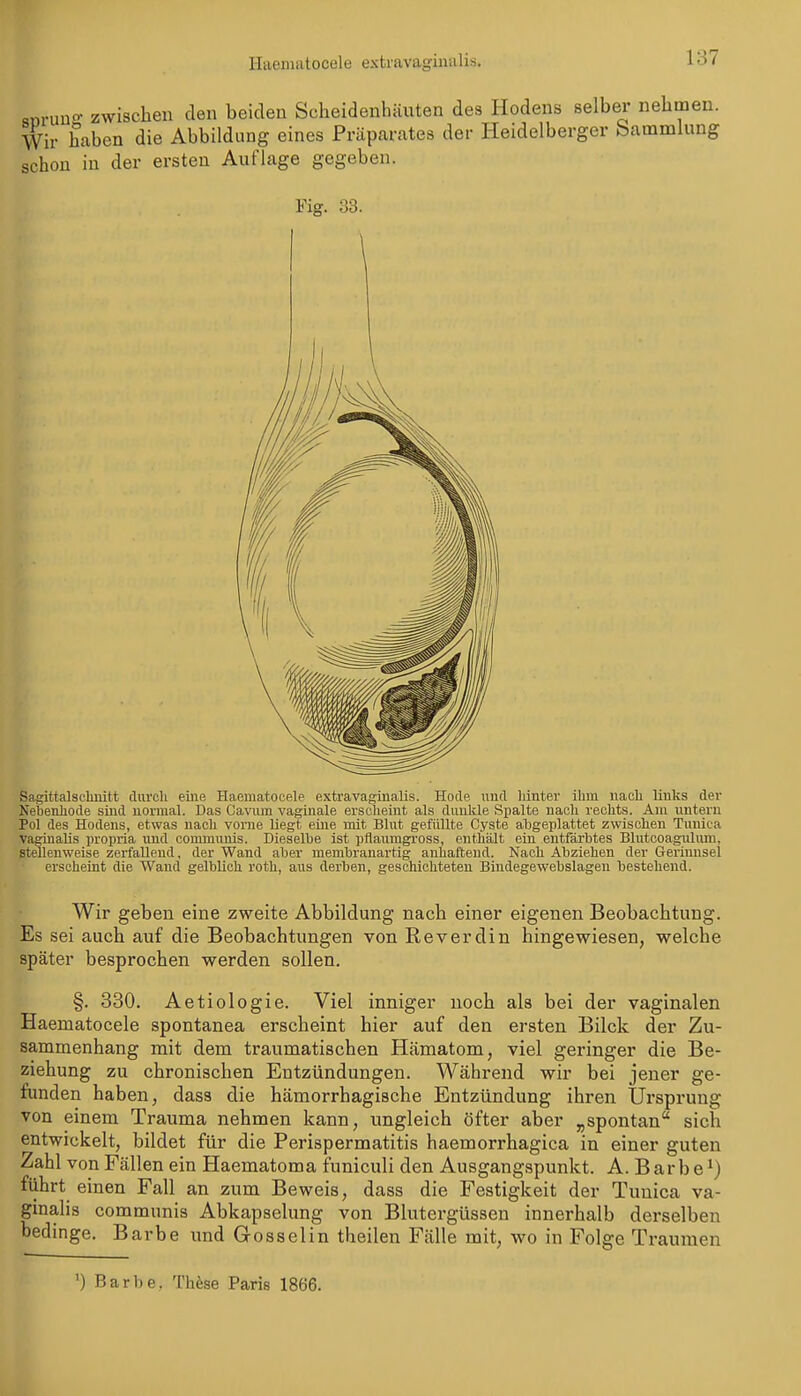 Haematocele extravagiiialis. «nruuo- zwischen den beiden Scheidenhäuten des Hodens selber nehmen. Wir haben die Abbildung eines Präparates der Heidelberger bammlung schon in der ersten Auflage gegeben. Fig. 33. Sagittalsclinitt cliii'cli eine Haematocele extra vaginalis. Hode nnd liinter ihm nacli links der Nebenhode sind normal. Das Cavum vaginale erscheint als dunkle Spalte nach rechts. Am untern Pol des Hodens, etwas nach vorne üegt eine mit Blut gefüllte Cyste abgeplattet zwischen Tunica vaginalis propria imd communis. Dieselbe ist pflaumgross, enthält ein entfärbtes Blutcoagulum, stellenweise zerfallend, der Wand aber membrauartig anhaftend. Nach Abziehen der Gerinnsel erscheint die Wand gelblich roth, aus derben, geschichteten Bindegewebslagen bestehend. Wir geben eine zweite Abbildung nach einer eigenen Beobachtung. Es sei auch auf die Beobachtungen von Reverdin hingewiesen, welche später besprochen werden sollen. §. 330. Aetiologie. Viel inniger noch als bei der vaginalen Haematocele spontanea erscheint hier auf den ersten Bilde der Zu- sammenhang mit dem traumatischen Hämatom, viel geringer die Be- ziehung zu chronischen Entzündungen. Während wir bei jener ge- funden haben, dass die hämorrhagische Entzündung ihren Ursprung von einem Trauma nehmen kann, ungleich öfter aber „spontan sich entwickelt, bildet für die Perispermatitis haemorrhagica in einer guten Zahl von Fällen ein Haematoma funiculi den Ausgangspunkt. A. Barbe'') führt^ einen Fall an zum Beweis, dass die Festigkeit der Tunica va- gmalis communis Abkapselung von Blutergüssen innerhalb derselben bedinge. Barbe und G osselin theilen Fälle mit, wo in Folge Traumen ') Barbe, Thfese Paris 1866.