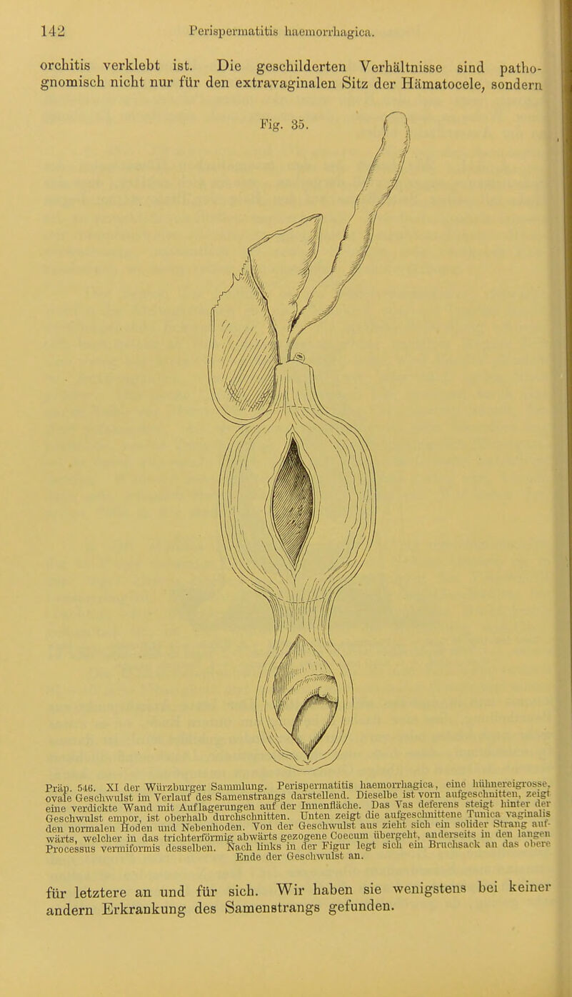 Orchitis verklebt ist. Die geschilderten Verhältnisse sind patho- gnomisch nicht nur für den extravaginalen Sitz der Hämatocele, sondern Fior. 35 Prän 5i6. XI der Würzbui-ger Sanunlung. Perispermatitis liaemonliagica, eine huhnereigrosse ovale Geschwulst im Verlauf des Samenstrangs darstellend. Dieselbe ist vorn aufgeschnitten zeigt eine verdickte Wand mit Auflagerungen auf der Innenfläche. Das \as deferens steigt hinter der Geschwulst empor, ist oberhalb durchsclmitten. Unten zeigt tUe autgeschnittene Tunic^ vaginalis den normalen Hoden und Nebenhoden. Von der Geschwulst aus zieht sich ein solider Sti-ang aut- wärts, welcher in das trichterförmig abwärts gezogene Coecum ubergeht, audereeits in den langen Processus vermiformis desselben. Nach Unks in der Figur legt sich ein Bruchsack an das obere Ende der Geschwulst an. für letztere an und für sich. Wir haben sie wenigstens bei keiner andern Erkrankung des Samenstrangs gefunden.
