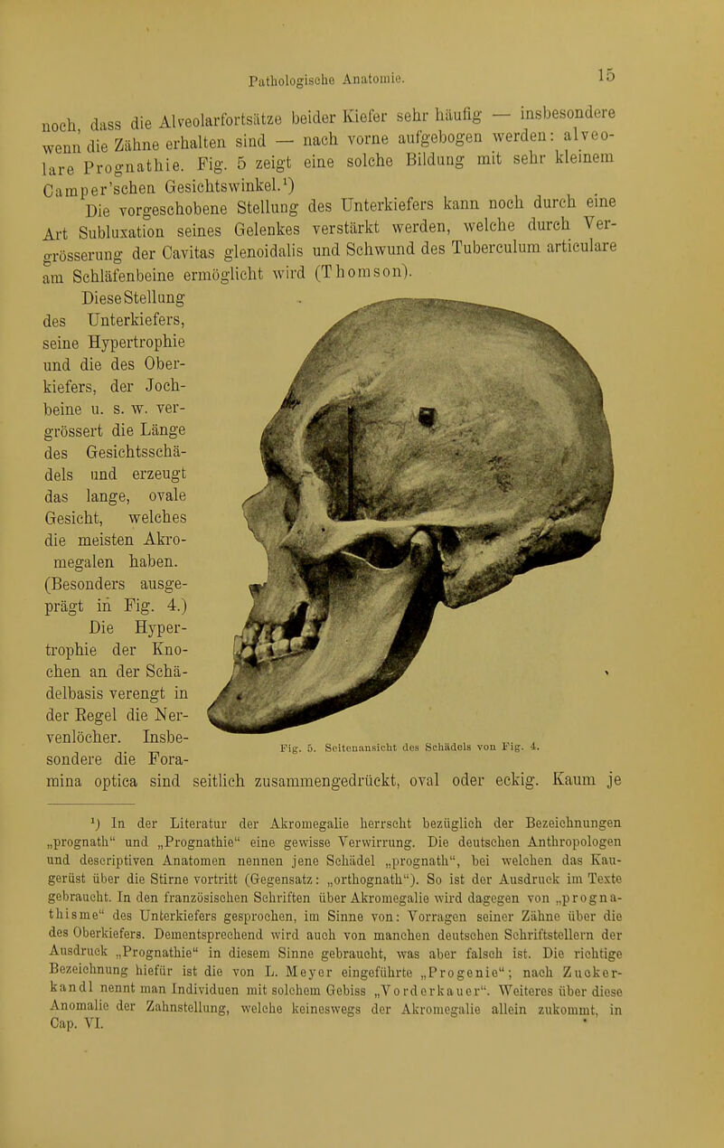 noch dass die Alveolarfortsätze beider Kiefer sehr häufig - insbesondere wenn die Zähne erhalten sind - nach vorne aufgebogen werden: alveo- lare Prognathie. Fig. 5 zeigt eine solche Bildung mit sehr kleinem Camper'schen Gesichtswinkel.0 _ Die vorgeschobene Stellung des Unterkiefers kann noch durch eme Art Subluxation seines Gelenkes verstärkt werden, welche durch Ver- grösserung der Cavitas glenoidalis und Schwund des Tuberculum articulare am Schläfenbeine ermöglicht wird (Thomson). Diese Stellung des Unterkiefers, seine Hypertrophie und die des Ober- kiefers, der Joch- beine u. s. w. ver- grössert die Länge des Gesichtsschä- dels und erzeugt das lange, ovale Gesicht, welches die meisten Akro- megalen haben. (Besonders ausge- prägt in Fig. 4.) Die Hyper- trophie der Kno- chen an der Schä- delbasis verengt in der Eegel die Ner- venlöcher. Insbe- sondere die Fora Fig. 5. Seitenansicht des Scliädels von Fig. 4. mina optica sind seitlich zusammengedrückt, oval oder eckig. Kaum je In der Literatur der Akromegalie herrscht bezüglich der Bezeichnungen „prognath und „Prognathie eine gewisse Verwirrung. Die deutschen Anthropologen und descriptiven Anatomen nennen jene Schädel „prognath, bei welchen das Kau- gerüst über die Stirne vortritt (Gegensatz: „orthognath). So ist der Ausdruck im Texte gebraucht. In den französischen Schriften über Akromegalie wird dagegen von „progna- thisme des Unterkiefers gesprochen, im Sinne von: Vorragen seiner Zähne über die des Oberkiefers. Dementsprechend wird auch von manchen deutsehen Schriftstellern der Ausdruck „Prognathie in diesem Sinne gebraucht, was aber falsch ist. Die richtige Bezeichnung hiefür ist die von L. Meyer eingeführte „Progenie; nach Zuoker- kandl nennt man Individuen mit solchem Gebiss „Vordorkauer. Weiteres über diese Anomalie der Zahnstellung, welche keineswegs der Akromegalie allein zukommt, in Cap. VI.