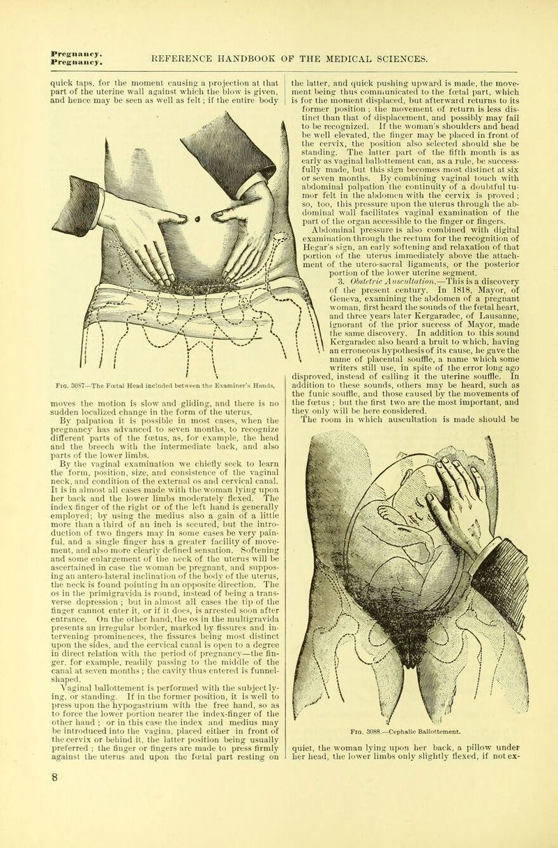 quick taps, for the moment causing a projection at that part of the uterine wall against which the blow is given, and hence may be seen as well as felt; if the entire body Fig. 30S7—The Fcetal Head included between the Examiner's Hands. moves the motion is slow and gliding, and there is no sudden localized change in the form of the viterus. By palpation it is possible in most cases, when the pregnancy has advanced to seven months, to recognize different parts of the foetus, as, for example, the head and the breech with the intermediate back, and also parts of the lower limbs. By the vaginal examination we chiefly seek to learn the form, position, size, and consistence of the vaginal neck, and condition of the external os and cervical canal. It is in almost all cases made with the woman lying upon her back and the lower limbs moderately flexed. The index-finger of the right or of the left hand is generally employerl; by using the medius also a gain of a little more than a third of an inch is secured, but the intro- duction of two fingers may in some cases be verj' pain- ful, and a single finger has a greater facility of move- ment, and also more clearly defined sensation. Softening and some enlargement of the neck of the uterus will be ascertained in case the woman be pregnant, and suppos- ing an antero-lateral inclination of the body of the uterus, the neck is found pointing in an opposite direction. The OS in the primigravida is round, instead of being a trans- verse depression ; but in almost all cases the tip of the finger cannot enter it, or if it does, is arrested soon after entrance. On the other hand, the os in the multigravida presents an irregular border, marked by fissures and in- tervening prominences, the fissures being most distinct upon the sides, and the cervical canal is open to a degree in direct relation with the period of pregnane}'—the fin- ger, for example, readily passing to the middle of the canal at seven months ; the cavity thus entered is funnel- shaped. Vaginal ballottement is performed with the subject ly- ing, or standing. If in the former position, it is well to press upon the hypogastrium with the free hand, so as to force the lower portion nearer the index-finger of the other hand ; or in this case the index and medius may be introduced into the vagina, placed either in front of the cervix or behind it, the latter position being usually preferred ; the finger or fingers are made to press firmly against the uterus and upon the fcetal part resting on the latter, and quick pushing upward is made, the move- ment being thus communicated to the fcetal part, which is for the moment displaced, but afterward returns to its former position ; the movement of return is less dis- tinct than that of displacement, and possibly may fail to be recognized. If the woman's shoulders and head be well elevated, the finger may be placed in front of the cervix, the position also selected should she be standing. The latter part of the fifth month is as early as vaginal ballottement can, as a rule, be success- fully made, but this sign becomes most distinct at six or seven months. By combining vaginal touch with abdominal palpation the continuity of a doubtful tu- mor felt in the abdomen with the cervix is proved ; so, too, this pressure upon the uterus through the ab- dominal wall facilitates vaginal examination of the part of the organ accessible to the finger or fingers. Abdominal pressure is also combined with digital examination through the rectum for the recognition of Hegar's sign, an earl)' softening and relaxation of that portion of the uterus immediately above the attach- ment of the utero-saoral ligaments, or the posterior portion of the lower uterine segment. 3. Obstetric A uscultation.—Tliis is a discovery of the present century. In 1818, Maj^or, of Geneva, examining the abdomen of a pregnant woman, first heard the sounds of the foetal heart, and three years later Kergaradec, of Lausanne, ignorant of the prior success of Mayor, made the same discovery. In addition to this sound Kergaradec also heard a bruit to which, having an erroneous hypothe.sis of its cau.se, he gave the name of placental souffle, a name which some writers still use, in spite of the error long ago disproved, instead of calling it the uterine souflle. In addition to these sounds, others may be heard, such as the funic souffle, and those caused by the movements of the foetus ; but the first two are the most important, and they only will be here considered. The room in which auscultation is made should be —Cephalic Ballociement. quiet, the woman lying upon her back, a pillow under her head, the lower limbs only slightly flexed, if not ex-