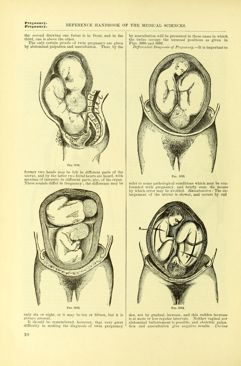 Pregnancy. REFERENCE HANDBOOK OF THE MEDICAL SCIENCES. the second drawing one fcEtus is in front, and in the third, one is above the other. The only certain proofs of twin pregnancy are given by abdominal palpation and auscultation. Thus, by the Fig. 3091. former two heads may be felt in different parts of the uterus, and by the latter two fcetal hearts are heard, with maxima of intensity in different parts, also, of the organ. These sounds differ in frequency ; the difference may be Fio. 3092. only six or eight, or it may be ten or fifteen, but it is always present. It sliould be remembered, however, that very great difficulty in making the diagnosis of twin pregnancy 10 by auscultation will be presented in those cases in which the twins occupy the unusual positions as given in Figs. 3091 and 3092. Differential Diagnosis of Pregnancy.—It is important ta Fig. .3093. refer to some pathological conditions which may be con- founded with pregnancy, and briefly state the means by which error may be avoided. Hmnatometra: The en- largement of the uterus is slower, and occurs by sud Fig. 3094. den, not by gradual, increase, and this sudden increase is at more or less regular intervals. Neither vaginal nor abdominal ballottement is po.ssihle, and obstetric palpa- tion and auscultation give negative results. Uterine-