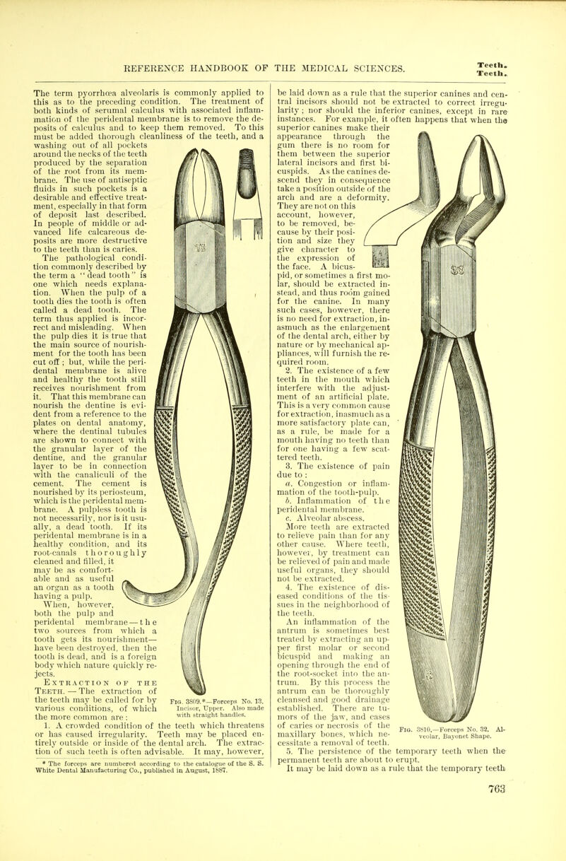 Teetli^ The term pyorrhoea alveolaris is commonly applied to this as to the preceding condition. The treatment of both kinds of serumal calculus with associated inflam- mation of the peridental membrane is to remove the de- posits of calculus and to keep them removed. To this must be added thorough cleanliness of the teeth, and a washing out of all pockets around the necks of the teeth produced by the separation of the root from its mem- brane. The use of antiseptic fluids in such pockets is a desirable and effective treat- ment, especially in that form of deposit last described. In people of middle or ad- vanced life calcareous de- posits are more destructive to the teeth than is caries. The pathological condi- tion commonly described by the term a  dead tooth is one which needs explana- tion. When the pulp of a tooth dies the tooth is often called a dead tooth. The term thus applied is incor- rect and misleading. When the pulp dies it is true that the main source of nourish- ment for the tooth has been cut off; but, while the peri- dental membrane is alive and healthy the tooth still receives nourishment from it. That this membrane can nourish the dentine is evi- dent from a reference to the plates on dental anatomy, where the dentinal tubules are shown to connect with the granular layer of the dentine, and the granular laj'er to be in connection with the canaliculi of the cement. The cement is nourished by its periosteum, which is the peridental mem- brane. A p\dpless tooth is not necessarily, nor is it usu- ally, a dead tooth. If its peridental membrane is in a healthy condition, and its root-canals thoroughly cleaned and filled, it may be as comfort- able and as useful an organ as a tooth having a pulp. When, however, both the pulp and peridental membrane — the two sources from which a tooth gets its nourishment— have been destroyed, then the tooth is dead, and is a foreign body which nature quickly re- jects. Extraction of the Teeth. — The extraction of the teeth may be called for by various conditions, of which the more common are : 1. A crowded condition of the teeth which threatens or has caused irregularity. Teeth may be placed en- tirely outside or inside of the dental arch. The extrac- tion of such teeth is often advisable. It may, however, * The forceps are iiumberert according to the catalogue of the S. S. White Dental Manufacturing Co., published in August, 1887. Fig. 3809.*—Forceps No. 1.3. Incisor, Upper. Also made with straight handles. be laid down as a rule that the superior canines and cen- tral incisors should not be extracted to correct irregu- larity ; nor should the inferior canines, except in rare- instances. For example, it often happens that when the superior canines make their appearance through the gum there is no room for them between the superior lateral incisors and first bi- cuspids. As the canines de- scend they in consequence take a position outside of the arch and are a deformity. They are not on this account, however, to be removed, be- cause by their posi- tion and size they give character to the expression of the face. A bicus- pid, or sometimes a first mo- lar, should be extracted in- stead, and thus room gained for the canine. In many such cases, however, there is no need for extraction, in- asmuch as the enlargement of the dental arch, either by nature or bj' mechanical ap- pliances, will furnish the re- ciuired room. 2. The existence of a few teeth in the mouth which interfere with the adjust- ment of an artificial plate. This is a very common cause for extraction, inasmuch as a more satisfactory plate can, as a rule, be made for a mouth having no teeth than for one having a few scat- tered teeth. 3. The existence of pain due to : a. Congestion or inflam- mation of the tooth-pulp. b. Inflammation of the peridental membrane. c. Alveolar abscess. More teeth are extracted to relieve pain than for any other cause. Where teeth, however, by treatment can be relieved of pain and made useful organs, they should not be extracted. 4. The existence of dis- eased conditions of the tis- sues in the neighborhood of the teeth. An inflammation of the antrum is sometimes best treated by extracting an up- per first molar or second bicuspid and making an opening through the end of the root-socket into the an- trum. By this process the antrum can be thoroughly cleansed and good drainage estaljlished. There are tu- mors of the jaw, and cases of caries or necrosis of the maxillary bones, which ne- cessitate a removal of teeth. 5. The persistence of the temporary teeth when the permanent teeth are about to erupt. It may be laid down as a rule that the temporary teeth 3810.—Forceps No. .32. Al- veolar, Bayonet Shape.