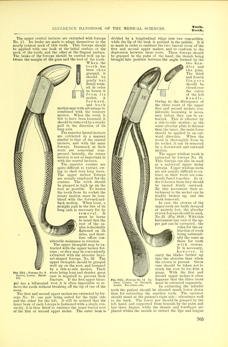 Teetbo The upper central incisors are extracted with forceps No. 13. Its beaks are made to adapt themselves to the nearly conical neck of this tooth. This forcep.s should be applied with one beak at the labial surface ot the neck of the tootli, and the other at the lingual surface. The beaks of the forceps should be carried well up be- tween the margin of the gum and the root of the tooth. When the tooth has been thus grasped, it should be gently but firmly rotat- ed, in order to loosen it from its socket. A forward- aud -back motion may with advantage be combined with the rotatory motion. When the tooth is felt to have been loosened, it should be removed by a steady pull in the direction of its long axis. The superior lateral incisors are extracted in a manner similar to that of the central incisors, and with the same forceps. Inasmuch as their roots are somewhat com- pressed laterally, the rotary motion is not so important as with the central incisors. The su]3erior canines are quite difficult to extract, ow- ing to their very long roots. The upper incisor forceps are usually employed for the canines. The tooth should be grasped as high up on the root as possible. To loosen the tooth from its socket the rotary motion must be com- bined with the forward-and- back motion. When loose, a straight pull in the line of its long axis is necessary for its removal. It must be borne in mind that the root of the ca- nine is decidedly flattened on its sides, and there- fore offers con- siderable resistance to rotation. The upper bicuspids may be ex- tracted with the upper incisor for- ceps ; or they ma}' be conveniently extracted with the alveolar bayo- net-shaped forceps. No. 32. The upper bicuspids should be grasped well up on the root, and loosened by a side-to-side motion. Their roots being long and slender, great care is required to prevent their fracture. If the first upper bicus- pid has a bifurcated root, it is often impossible to re- move the tooth without breaking off the tip of one of the roots. The first and second upper molars are extracted by for- ceps No. 18 ; one pair being suited for the right side and the other for the left. It will be noticed that the inner beak of each forceps is fashioned with a single con- cavity, it is thus fitted to embrace the inner buccal root of the first or second upper molar. The outer beak is FlO. 3814.—Forceps No. 9. Incipor, Lower, Httwk- bill. m divided by a longitudinal ridge into two concavities, while the tip of the beak is pointed in the middle. It is so made in order to embrace the two buccal roots of the first and second upper molars, and to conform to the depression between these roots. These forceps should be grasped in the palm of the hand, the thumb being brought into position between the angle formed by the two han- dles and the joint. The third and fourth fingers should be closed over the curve of the left h a n d 1 e. Owing to the divergence of the three roots of the upper first and second molars, con- siderable loosening is neces- sary liefore they can be ex- tracted. This is effected by a side-to-side motion ; as the- outer alveolar jilate is thinner than the inner, the main force should lie applied in an out- ward direction. When the toolli is thorouglily loose in its socket, it can be removed by a downward and outward motion. The upper wisdom tooth is extracted by forceps No. 10. This forceps can also be used as a universal upper molar forceps. Upper wisdom teeth are not usually ditticult to ex- tract, as their roots are com- monly fused together. In or- der to loosen them they should be turned firralj' outward. By this movement their at- tachment to the socket can be readily l)roken up, and the- tooth removed. In case the crowns of the upper teeth are badly decayed or entirely lost, the alveolar or root-forceps should be used. No. 32. (Fig. 3810.) With this instrument any root of the up- per jaw can be extracted ; the ndes for the ex- traction of roots being substanti- ally the same as those for teeth with crowns. It is nece-ssary, however, to carry the blades farther up into the alveolus than when the crown is present. Great care should be taken not to crush the root by too firm a grasp. With the first and second upper molars it often happens that the three roots must be extracted separately. In extracting the inferior teeth the patient should be situated much lower down than for extracting the superior teeth. The operator should stand at the patient's right side ; oftentimes well to the back. The lower jaw should be grasped by the left hand, and supported from beneath by the palm and last three fingers, while the thumb and forefinger are placed within the mouth to retract the lips and tongue few mm. Fig, 3815.—Forceps No. 14. In- cisor, Canine, or Bicuspiil, Lower. For either side.