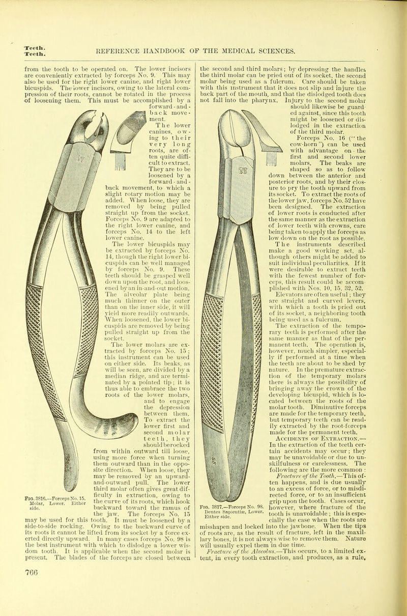 Teetli. REFERENCE HANDBOOK OP THE MEDICAL SCIENCES. from the tooth to be operated on. The lower incisors are conveniently extracted by forceps No. 9. This may also be used for the right lower canine, and right lower bicuspids. The iower incisors, owing to the lateral com- pression of their roots, cannot be rotated in tlie process of loosening them. This must be accomplished by a forward-and- /\ back move- ' ment. The lower canines, o w - ing to their very long roots, are of- ten quite diffi- cult to extract. Tliey are to be loosened by a forward - and - back movement, to which a slight rotary motion may be added. When loose, they are removed by being pulled straight vip from the socket. Forceps No. 9 are adapted to the right lower canine, and forceps No. 14 to the left lower canine. The lower bicuspids may be extracted by forceps No. 14, though the right lower bi- cuspids can be well managed by forceps No. 9. Tliese teeth should be grasped well down upon the root, and loos- ened by an in-and-out motion. The alveolar plate being much thinner on the outer than on the inner side, it will 3'ield more readily outwards. When loosened, the lower bi- cuspids are removed by being pulled straight up from the The lower molars are ex- tracted by forceps No. 15 ; this instrument can be used on either side. Its beaks, as will l)e seen, are divided by a median ridge, and are termi- nated bj' a pointed tip; it is thus able to embrace the two roots of the lower molars, and to engage the depression between them. To extract the lower first and second m o 1 a r teeth, they should berocked from within outward till loose, using more force when turning them outward than in the oppo- site direction. When loose, they may be removed by an upward- and-outward pull. The lower third molar often gives great dif- ficulty in extraction, owing to the curve of its roots, which hook backward toward the ramus of the jaw. The forceps No. 15 may be used for this tooth. It must be loosened by a side-to-side rocking. Owing to the backward curve of its roots it cannot be lifted from its socket by a force ex- erted directly upward. In many cases forceps No. 98 is the best instrument with which to dislodge a lower wis- dom tooth. It is applicable when the second molar is present. The blades of the forceps are closed between Fig. 3816.—Forceps No. 15. Molar, Lower. Either side. the second and third molars; by depressing the handles the third molar can be pried out of its socket, the second molar being used as a fulcrum. Care should be taken with this instrument that it does not slip and injure the back part of the mouth, and that the dislodged tooth does not fall into the pharynx. Injury to the second molar should likewise be guard ed against, since this tooth might be loosened or dis- lodged in the extraction of the third molar. Forceps No. 16 ( the cow-horn) can be used with advantage on • the !,.,] first and second lower i'l'iM molars. The beaks are shaped so as to follow down between the anterior and posterior roots, and by their clos- ure to pry the tooth upward from its socket. To extract the roots of the lower jaw, forceps No. 52 have been designed. The extraction of lower roots is conducted after the same manner as the extraction of lower teeth with crowns, care being taken to apply the forceps as low down on the root as possible. The instruments described make a good working set, al- though others might be added to suit individual peculiarities. If it were desirable to extract teeth with the fewest number of for- ceps, this result could be accom plished with Nos. 10, 15, 32, 52. Elevators are often useful; they are straight and curved levers, with which a tooth is pried out of its socket, a neighboring tooth being used as a fulcrum. The extraction of the tempo- rary teeth is performed after the same manner as that of the per- manent teeth. The operation is, however, much simpler, especial- ly if performed at a time when the teeth are about to be shed by nature. In the premature extrac- tion of the temporary molars there is always the possibility of bringing away the crown of the developing bicuspid, which is lo- cated between the roots of the molar tooth. Diminutive forceps are made for the temporary teeth, but temporary teeth can be read- ily extracted by the root-forceps made for the permanent teeth. Accidents of Extkaction.— In the extraction of the teeth cer- tain accidents may occur; they may be unavoidable or due to un- skilfulness or carelessness. The following are the more common ; Fracture of the Tooth.—This of- ten happens, and is due usually to an excess of force, or to misdi- rected force, or to an insufficient grip upon the tooth. Cases occur, however, where fracture of the tooth is unavoidable ; this is espe- cially the case when the roots are misshapen and locked into the jawbone. When the tips of roots are, as the result of fracture, left in the maxil- lary bones, it is not always wise to remove them. Nature will usually expel them in due time. Fracture of the Alveolus.—This occurs, to a limited ex- tent, in every tooth extraction, and produces, as a rule. Hi •Vj if I /7V Fio. .5817.—Forceps No. 98, Denies Sapientiae, Lower, Either side.