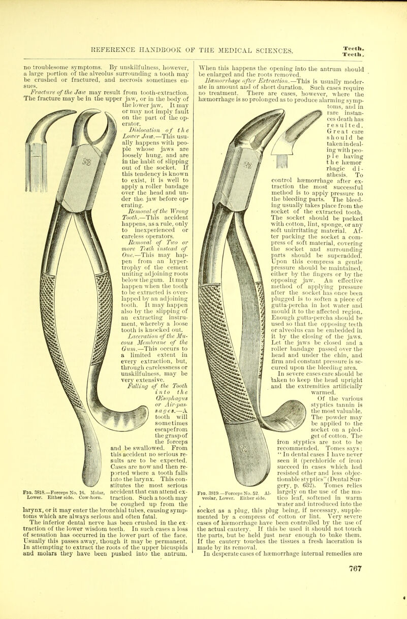 Teetli, no troublesome sj'mptoms. By imskilfulness, however, a large portion of the alveolus surrounding a tooth may be crushed or fractured, and necrosis sometimes en- sues. Fracture of the Jaw may result from tooth-extraction. The fracture may be in the upper jaw, or in the body of the lower jaw. It may or may not imply fault on the part of the op- erator. Diilocation of the Lower Jaw.—This usu- ally happens with peo- ple whose jaws are loosely hung, and are in the habit of slipping out of the socket. If this tendency is known to e.xist, it is well to apply a roller bandage over the head and un- der the jaw before op- erating. Removal of the Wrong Tooth.—Thh accident happens, as a rule, only to inexperienced or careless operators. Removal of Tioo or more Teelh instead of One.—This may hap- pen from an hyper- trophj^ of the cement uniting adjoining roots below the gum. It may happen when the tooth to l)e extracted is over- lapped by an adjoining tooth. It may happen also by the slipping of an extracting instru- ment, whereby a loose tooth is knocked out. Laceration of the Mu- cous Memhrune of the Gum.—This occurs to a limited extent in every extraction, but, through carelessness or unskilfulness, may be very extensive. Falling of the Tooth into the CEsophagus or Air-pas- sages.—A tooth will sometimes escapefrom the grasp of the forceps and be swallowed. From this accident no serious re- sults are to be expected. Cases are now and then re- ported where a tooth falls into the larynx. This con- stitutes the most serious accident that can attend ex- traction. Such a tooth may be coughed up from the larynx, or it may enter the bronchial tubes, causing symp- toms which are always serious and often fatal. The inferior dental nerve has been crushed in the ex- traction of the lower wisdom teeth. In such cases a loss of sensation has occurred in the lower part of the face. Usually this passes away, though it may be permanent. In attempting to extract the roots of the upper bicuspids and molars they have been pushed into the antrum. Fig. 3818.—Forceps No. Ki. Molar, Lower. Either side. Cow-horn. When this happens the opening into the antrum should be enlarged and the roots removed. Ummorrhage iftcr F.vtrac(ion.—Thia is usually moder- ate in amount and of short duration. Such cases require no treatment. There are cases, however, wliere the hfemorrhage is so prolonged as to produce alarming symp- toms, and in rare instan- ces death has resulted. Great care should be taken in deal- ing with peo- p 1 e having the liiemor rliagic d i - athesis. To control ha?morrhage after ex- traction the most successful method is to apply pressure to the bleeding parts. The bleed- ing usually takes place from the socket of the extracted tooth. The socket should be packed with cotton, lint, sponge, or any soft unirritating material. Af- ter packing the socket a com- press of soft material, covering the socket and surrounding parts should be superadded. Upon this compress a gentle pressure should be maintained, either by the fingers or by the opposing jaw. An effective method of applying pressure after the socket has once been plugged is to soften a piece of gutta-percha in hot water and mould it to the affected region. Enough gutta-percha shouTd be used so that the opposing teeth or alveolus can be embedded in it by the closing of the jaws. Let the jaws be closed and a roller bandage passed o\'er the head and under the chin, and firm and constant pressure is se- cured upon the bleeding area. In severe cases care should be taken to keep the head upiight and the extremities artificially warmed. Of the various styptics tannin is the most valuable. The powder may be applied to the socket on a pled- get of cotton. The iron styptics are not to be recommended. Tomes says:  In dental cases I have never seen it (perchloride of iron) succeed in cases which had resisted other and less objec- tionable styptics (Dental Sur- gerj', p. 632). Tomes relies largely on the use of the nia- tico leaf, softened in wai'm water and introduced into the socket as a plug, this plug being, if nece.ssary, supple- mented by a compress of cotton or lint. Very severe cases of haemorrhage have been controlled by the use of the actual cautery. If this be used it should not touch the parts, but be held just near enough to bake them. If the cautery touches the tissues a fresh laceration is made by its removal. In desperate cases of haemorrhage internal remedies are Fia. .3819.—Forceps No. 5-3. Al- veolar, Lower. Either side.