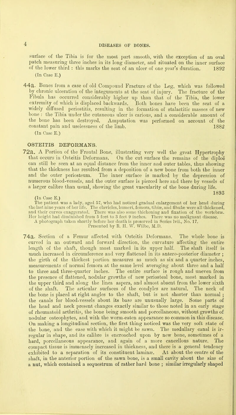 surface of the Tibia is for the most part smootli, with the exception of an oval patch measuring three inches in its long diameter, and situated on the inner surface of the lower third : this marks the seat of an ulcer of one year's duration. 1892 (In Case E.) 44a. Bones from a case of old Compound Fracture of the Leg, which was followed by chronic ulceration of the integuments at the seat of injury. The fracture of the Fibula has occurred considerably higher up than that of the Tibia, the lower extremity of which is displaced backwards. Both bones have been the seat of a widely diffused periostitis, resulting in the formation of stalactitic masses of new bone : the Tibia under the cutaneous ulcer is carious, and a considerable amount of the bone has been destroyed. Amputation was performed on account of the constant pain and uselessness of the limb. 1882 (In Case E.) OSTEITIS DEFORMANS. 72a. A Portion of the Frontal Bone, illustrating very well the great Hypertrophy that occurs in Osteitis Deformans. On the cut surface the remains of the diploe can still be seen at an equal distance from the inner and outer tables, thus sliowing that the thickness has resulted from a deposition of a new bone from both the inner and the outer periosteum. The inner surface is marked by the depression of numerous blood-vessels, and the outer surface is pierced here and there by vessels of a larger calibre than usual, showing the great vascularity of the bone during life. 1893 (In Case E.) The patient was a lady, aged 57, who had noticed gradual enlargement of her head during the last nine years of her life. The clavicles, humeri, femora, tibise, and flbul^ were all thickened, and their curves exaggerated. There was also some thickening and fixation of the vertebrfe. Her height had diminished from 5 feet to 3 feet 9 inches. There was no malignant disease. A photograph taken shortly before her death is preserved in Series Ivii., No. 17. Presented by R. H. W. Wilbe, M.D. 74a- Section of a Femur affected with Osteitis Deformans. The whole bone is curved in an outward and forward direction, the curvature affecting the entire length of the shaft, though most marked in its upper half. The shaft itself is much increased in circumference and very flattened in its antero-posterior diameter ; the girth of the thickest portion measures as much as six and a quarter inches, measurements of normal femora at the same level averaging about three and a half to three and three-quarter inches. The entire surface is rough and uneven from the presence of flattened, nodular growths of new periosteal bone, most marked in the upper third and along the linea aspera, and almost absent from the lower sixth of the shaft. The articular surfaces of the condyles are natural. The neck of the bone is placed at right angles to the shaft, but is not shorter than normal ; the canals for blood-vessels about its base are unusually large. Some parts of the head and neck present changes exactly similar to those noted in an early stage of rheumatoid arthritis, the bone being smooth and porcellaneous, without growths of nodular osteophytes, and with the worm-eaten appearance so common in this disease. On making a longitudinal section, the first thing noticed was the very soft state of the bone, and the ease with which it might be sawn. The medullary canal is ir- regular in shape, and its calibre is encroached upon by new bone, sometimes of a hard, porcellaneous appearance, and again of a more cancellous nature. The compact tissue is immensely increased in tliickness, and there is a general tendency exhibited to a separation of its constituent laminaa. At about the centre of the shaft, in the anterior portion of the sawn bone, is a small cavity about the size of a nut, which contained a sequestrum of rather hard bone ; similar irregularly shaped