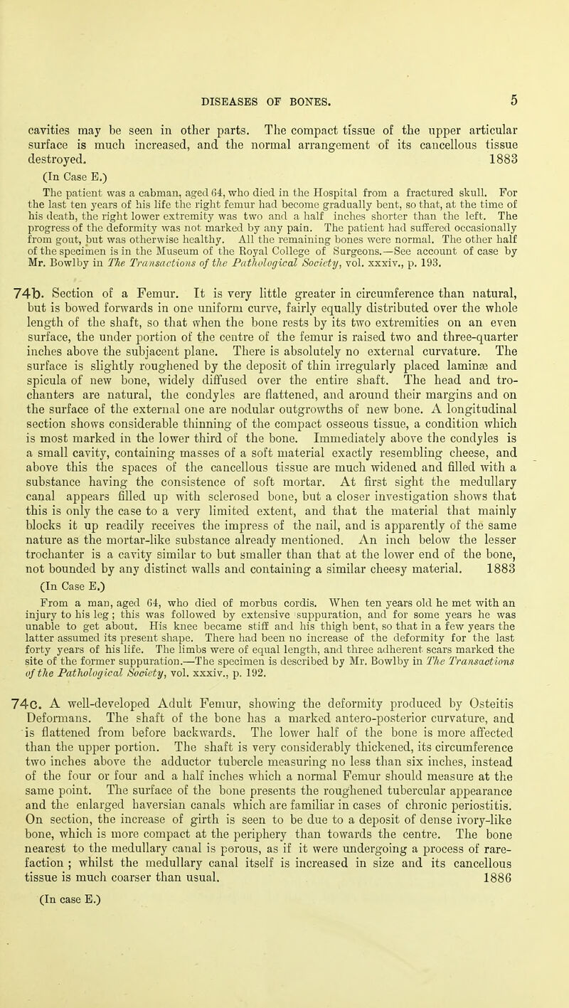 cavities may be seen in other parts. The compact tissue of the upper articular surface is mucli increased, and the normal arrangement of its cancellous tissue destroyed, 1883 (In Case E.) The patient was a cabman, aged 64, who died in the Hospital from a fractured skull. For the last ten years of his life the right femur had become gradually bent, so that, at the time of his death, the right lower extremity was two and a half inches shorter than the left. The progress of the deformity was not marked by any pain. The patient had suffered occasionally from gout, but was otherwise healthy. All the remaining bones were normal. The other half of the specimen is in the Museum of the Royal College of Surgeons.—See account of case by Mr. Bowlby in The Transactions of the Patliological Society, vol. xxxiv., p. 193. 74b. Section of a Femur. It is very little greater in circumference than natural, but is bowed forwards in one uniform curve, fairly equally distributed over the whole length of the shaft, so that when the bone rests by its two extremities on an even surface, the under portion of the centre of the femur is raised two and three-quarter inches above the subjacent plane. There is absolutely no external curvature. The surface is slightly roughened by the deposit of thin irregularly placed laminae and spicula of new bone, widely diffused over the entire shaft. The head and tro- chanters are natural, the condyles are flattened, and around their margins and on the surface of the external one are nodular outgrowths of new bone. A longitudinal section shows considerable thinning of the compact osseous tissue, a condition which is most marked in the lower third of the bone. Immediately above the condyles is a small cavity, containing masses of a soft material exactly resembling cheese, and above this the spaces of the cancellous tissue are much widened and filled with a substance having the consistence of soft mortar. At first sight the medullary canal appears filled up with sclerosed bone, but a closer investigation shows that this is only the case to a very limited extent, and that the material that mainly blocks ifc up readily receives the impress of the nail, and is apparently of the same nature as the mortar-like substance already mentioned. An inch below the lesser trochanter is a cavity similar to but smaller than that at the lower end of the bone, not bounded by any distinct walls and containing a similar cheesy material. 1883 (In Case E.) From a man, aged 64, who died of morbus cordis. When ten years old he met with an injury to his leg; this was followed by extensive isuppuration, and for some years he was unable to get about. His knee became stiff and his thigh bent, so that in a few years the latter assumed its present shape. There had been no increase of the deformity for the last forty years of his life. The limbs were of equal length, and three adherent scars marked the site of the former suppuration.—The specimen is described by Mr. Bowlby in The Transactions uf the Patholugical Society, vol. xxxiv., p. 192. 74c. A well-developed Adult Femur, showing the deformity produced by Osteitis Deformans. The shaft of the bone has a marked antero-posterior curvature, and is flattened from before backwards. The lower half of the bone is more affected than the upper portion. The shaft is very considerably thickened, its circumference two inches above the adductor tubercle measuring no less than six inches, instead of the four or four and a half inches which a normal Femur should measure at the same point. The surface of the bone presents the roughened tubercular appearance and the enlarged haversian canals which are familiar in cases of chronic periostitis. On section, the increase of girth is seen to be due to a deposit of dense ivory-like bone, which is more compact at the periphery than towards the centre. The bone nearest to the medullary canal is porous, as if it were undergoing a process of rare- faction ; whilst the medullary canal itself is increased in size and its cancellous tissue is much coarser than usual. 1886 (In case E.)