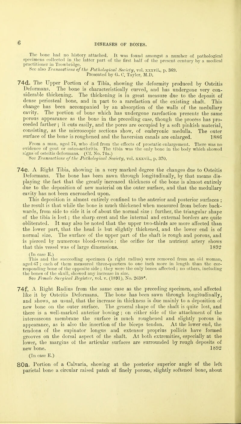 The bone had no history attached. It was found amongst a number of patholosical specimens collected in the latter part of the first half of the present century by a medical practitioner in Trowbridge. See also Trnnsnctions of the PatJwlugical Socivty, vol. xxxvii., p. 369. Presented by G. C. Tayler, M.D. 74 d. The Upper Portion of a Tibia, showing the deformity produced by Osteitis Deformans. The bone is characteristically curved, and has undergone very con- sideral5le thickening. The thickening is in great measure due to the deposit of dense periosteal bone, and in part to a rarefaction of the existing shafts This change has been accompanied by an absorption of the walls of the medullary cavity. The portion of bone which has undergone rarefaction presents the same porous appearance as the bone in the preceding case, though the process has pro- ceeded farther ; it cuts easily, and the pores are occupied by a soft pinkish material, consisting, as the microscopic sections show, of embryonic medulla. The outer surface of the bone is roughened and the haversian canals are enlarged. 1886 From a man, aged 7t, who died from the effects of prostatic enlargement. There was no evidence of gout or osteo-arthritis. The tibia was the only bone in the body which showed signs of osteitis deformans. (Cf. No. 74a.) See Transactions of the Pathological Society, vol. xxxvii., p. 370. 74e. A Right Tibia, showing in a very marked degree the changes due to Osteitis Deformans. The bone has been sawn through longitudinally, by that means dis- playing the fact that the greatly increased thickness of the bone is almost entirely due to the deposition of new material on the outer surface, and that the medullary cavity has not been encroached upon. This deposition is almost entirely confined to the anterior and posterior surfaces ; the result is that while the bone is much thickened when measured from before back- wards, from side to side it is of about the normal size : further, the triangular shape of the tibia is lost; the sharp crest and the internal and external borders are quite obliterated. It may also be noted that the upper two-thirds are more affected than the lower part, that the head is but slightly thickened, and the lower end is of normal size. The surface of the upper part of the shaft is rough and porous, and is pierced by numerous blood-vessels : the orifice for the nutrient artery shows that this vessel was of large dimensions. 1892 (In case E.) This and the succeeding specimen (a right radius) M'ere removed from an old woman, aged 07 ; each of them measured three-quarters to one inch more in length than the cor- responding bone of the opposite side ; they were the only bones affected ; no others, including the bones of the skull, showed any increase in size. See Female Surgical Register, vol. v. (1891), No. 2639*. 74f. A Right Radius from the same case as the preceding specimen, and affected like it by Osteitis Deformans. The bone has been sawn through longitudinally, and shows, as usual, that the increase in thickness is due mainly to a deposition of new bone on the outer surface. The general shape of the shaft is quite lost, and there is a well-marked anterior bowing ; on either side of the attachment of the interosseous membrane the surface is much roughened and slightly porous in appearance, as is also the insertion of the biceps tendon. At the lower end, the tendons of the supinator longus and extensor proprius pollicis have formed grooves on the dorsal aspect of the shaft. At both extremities, especially at the lower, the margins of the articular surfaces are surrounded by rough deposits of new bone. 1892 (lu case E.) 80a. Portion of a Calvaria, showing at the posterior superior angle of the left parietal bone a circular raised patch of finely porous, slightly softened bone, about